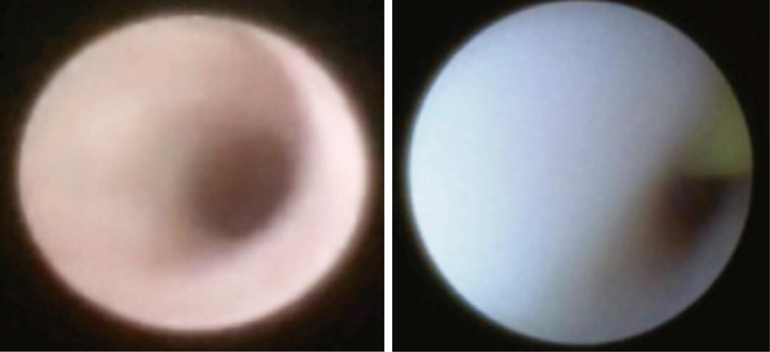 Fig. 83.9, Endoscopic view of a normal salivary duct (left) and a blanched, narrowed duct with loss of normal vascular markings (right) .