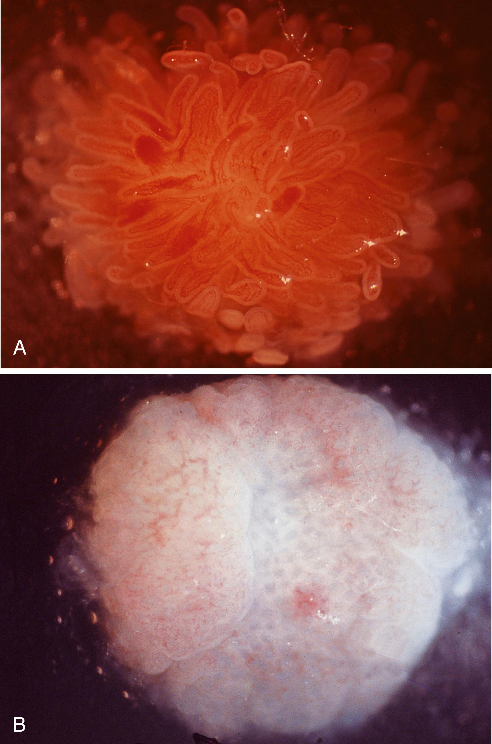 FIGURE 16.2, A, Normal small bowel mucosa viewed with a dissecting microscope (zirconium arc lighting). The villi are slender and translucent, allowing visualization of the underlying delicate capillary network (unstained). B, Small bowel mucosa from a patient with celiac disease. The surface is irregular and devoid of villi (unstained).