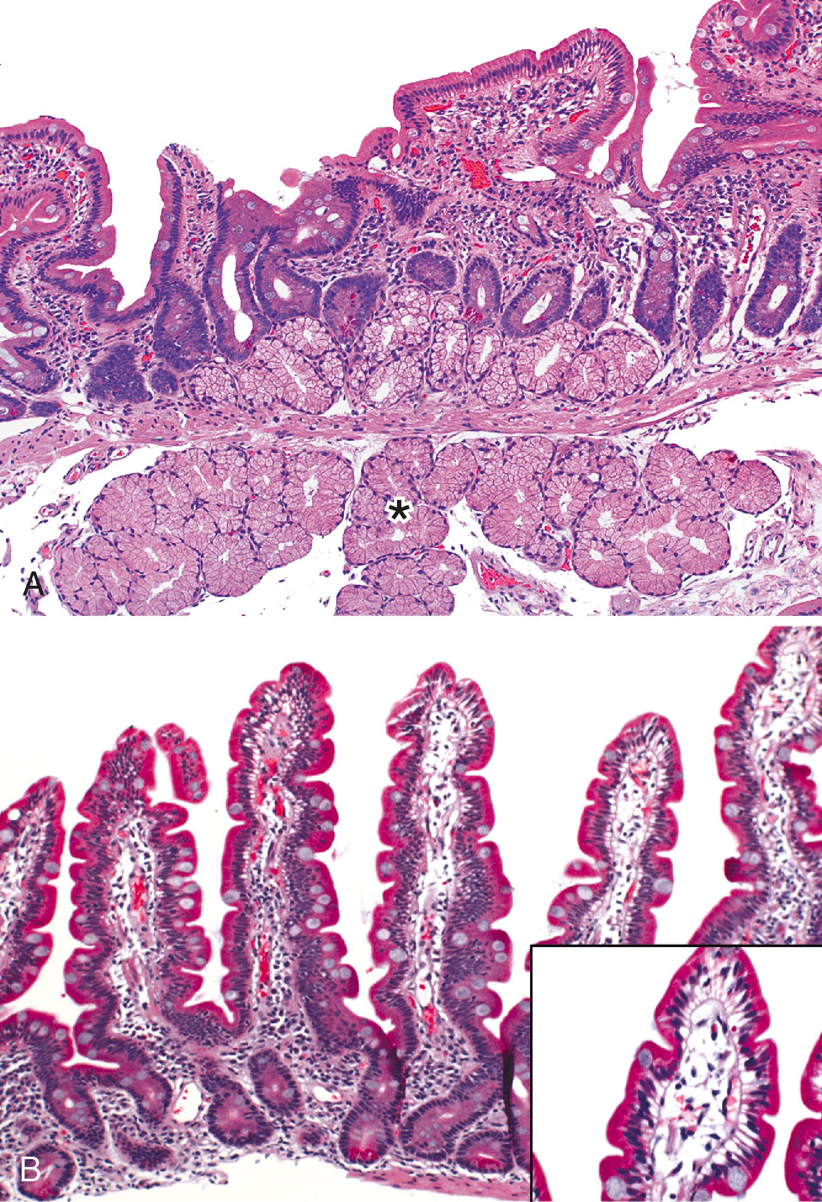 FIGURE 16.3, A, Normal duodenal bulb. The duodenal bulb is a transition zone that is normally subjected to physiological peptic injury. Brunner glands (asterisk) and increased mononuclear inflammation are frequently present in the mucosa, resulting in broader and shorter villi. B, Normal second duodenum and proximal jejunum. The villous-to-crypt ratio is between 3:1 and 5:1. There are, on average, two intraepithelial lymphocytes per 10 enterocytes (inset).