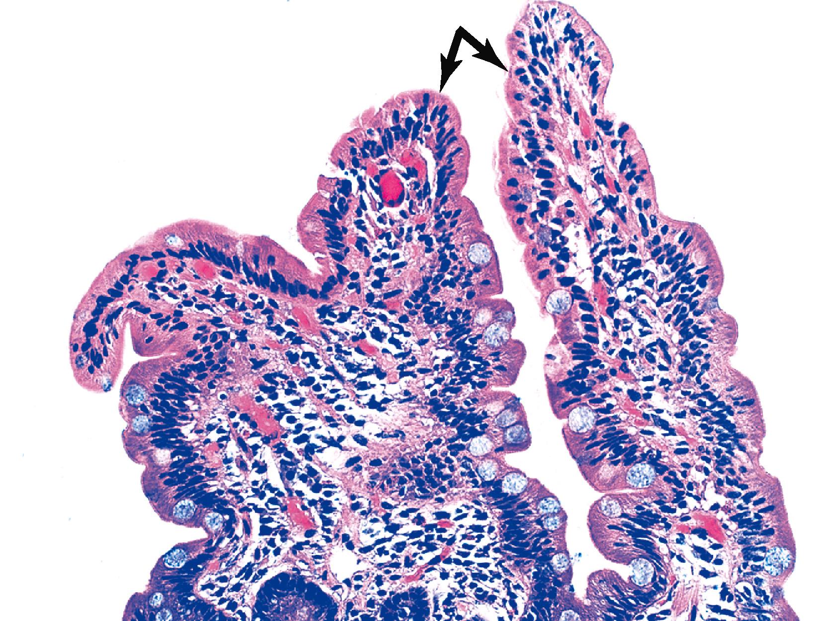 FIGURE 16.4, Untreated celiac disease. This duodenal biopsy was taken from an asymptomatic patient who was discovered to have antitissue transglutaminase antibodies. Normal villi are present, but there is a marked increase in the number of intraepithelial lymphocytes (arrows).