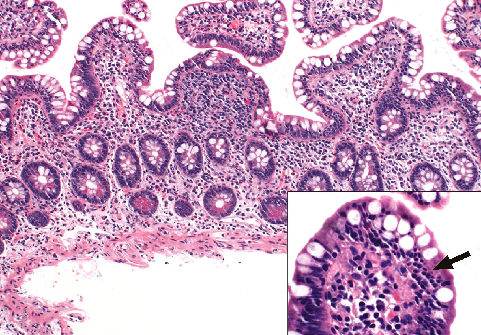 FIGURE 16.6, Viral gastroenteritis. This biopsy specimen from the second duodenum reveals mild villous blunting and a marked increase in the number of intraepithelial lymphocytes (arrow in inset). Viral studies revealed acute infection with rotavirus in this patient, who recovered spontaneously.