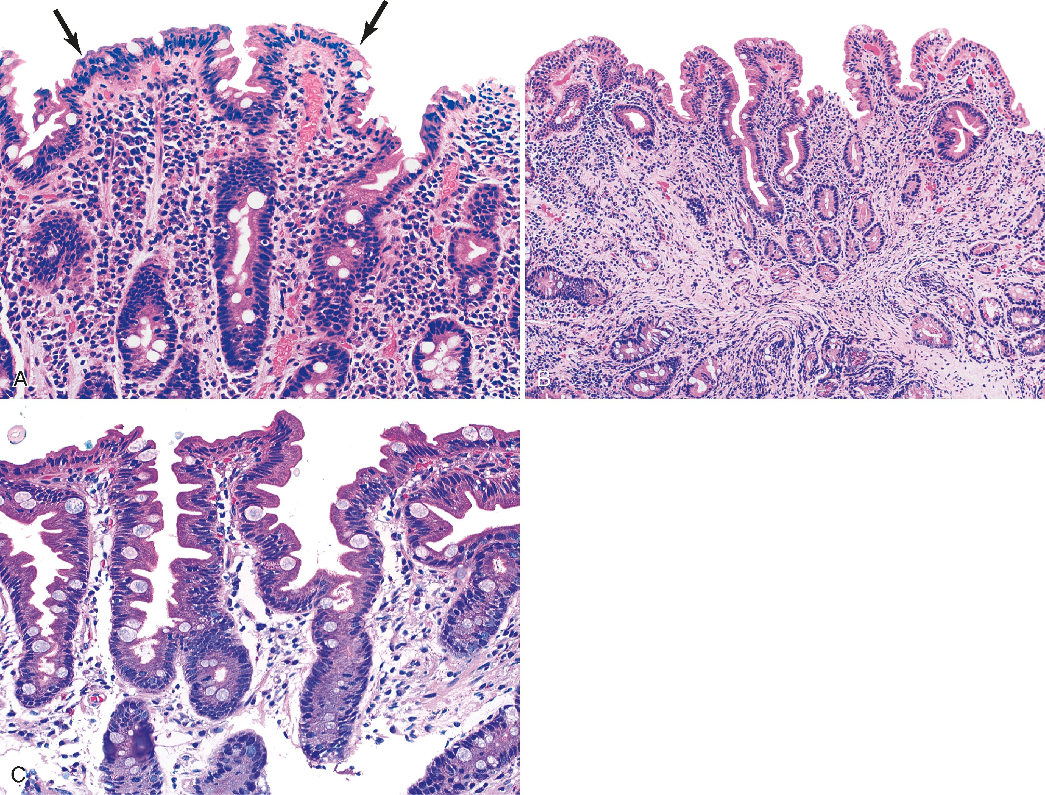 FIGURE 16.7, Celiac disease.