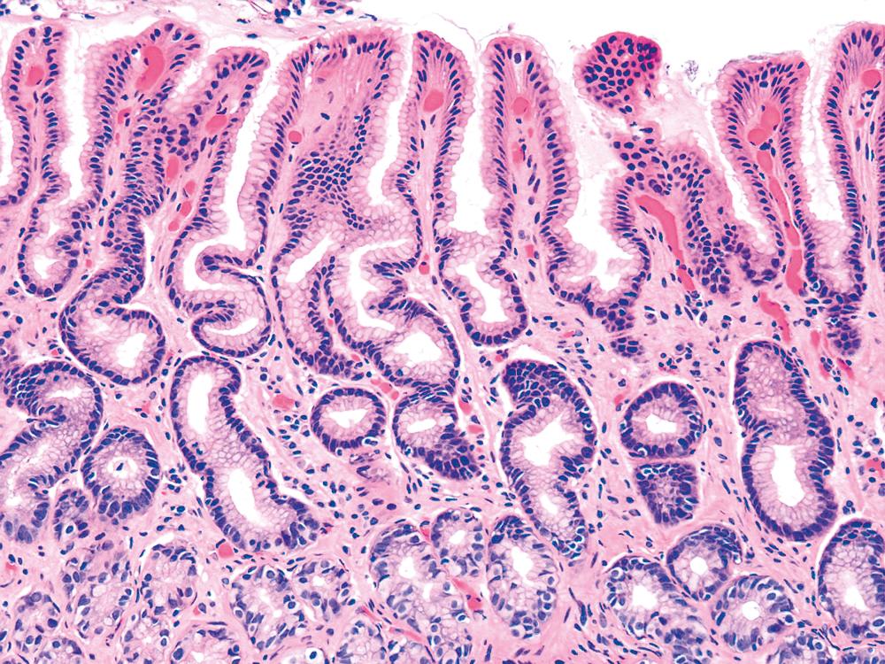 FIGURE 15.2, The normal gastric antrum may contain rare lymphocytes, plasma cells, and eosinophils in the lamina propria, as well as thin strands of smooth muscle. Examination of the distal antrum reveals an extended neck region that results in a mild tortuosity and villous-like configuration of the epithelium.