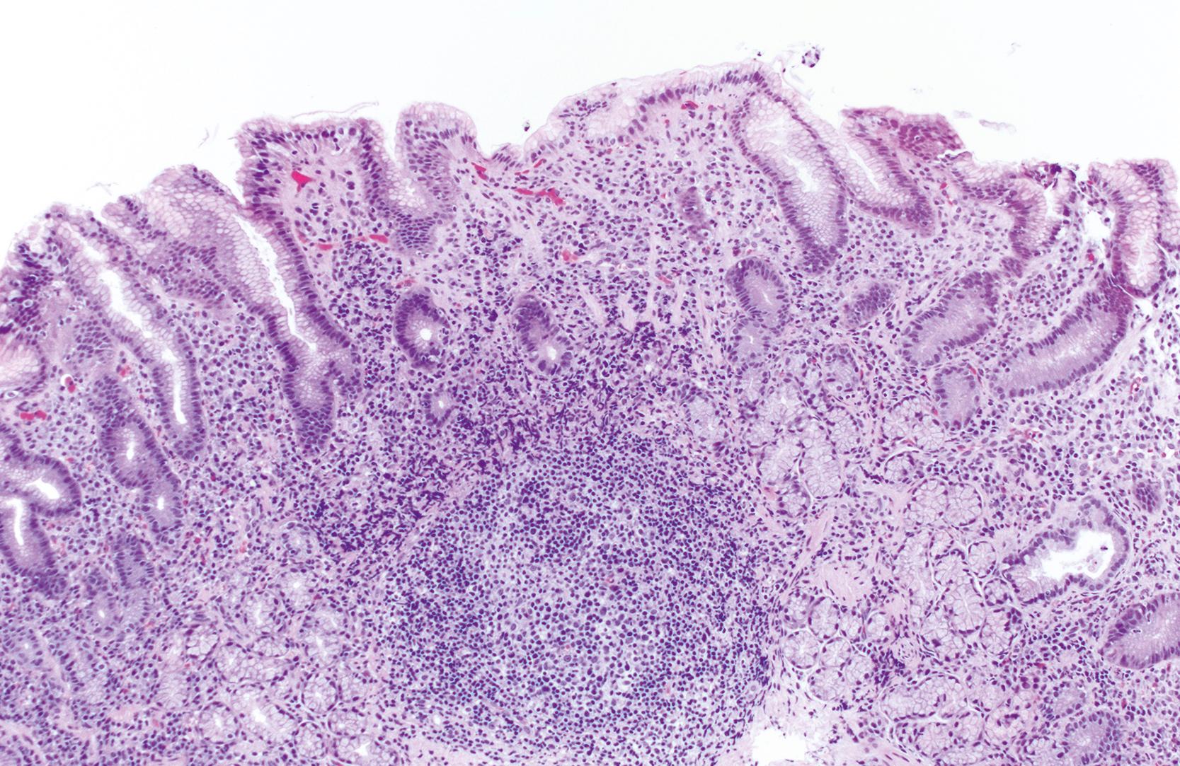 FIGURE 15.3, Antral mucosa with well-developed lymphoid follicle in a patient with Helicobacter pylori gastritis. Neither lymphoid aggregates nor follicles are found in the normal antrum.