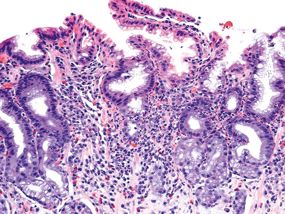 FIGURE 15.4, Eosinophils may compose some portion of the inflammatory infiltrate in Helicobacter pylori gastritis.