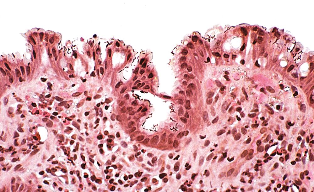 FIGURE 15.6, Surface epithelial degeneration (i.e., mucin-depleted epithelial cells) is typically found in Helicobacter pylori –infected stomachs, even in areas where bacteria are rare or absent. Focal loss of cells (i.e., microerosions) is evident. Bacteria occupy the empty spaces created by dropout of individual cells and areas of mucin depletion (silver triple stain).