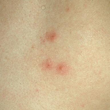 Inflammatory Papules - Clinical Tree