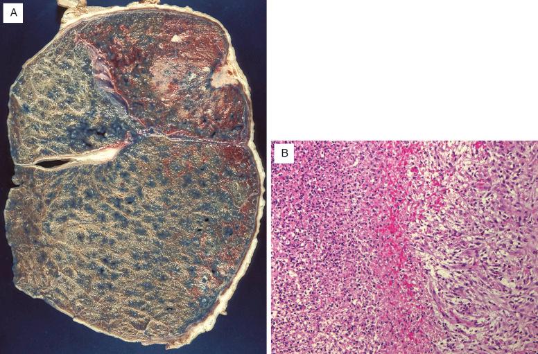 FIG. 34.2, Acute bacterial pleuritis (empyema). (A) The pleural exudate lies immediately adjacent to the pneumonic consolidation but also extends along the pleural surfaces and into the interlobar fissure. (B) This high-power view shows dense acute inflammatory exudate on the left and granulation tissue on the right.