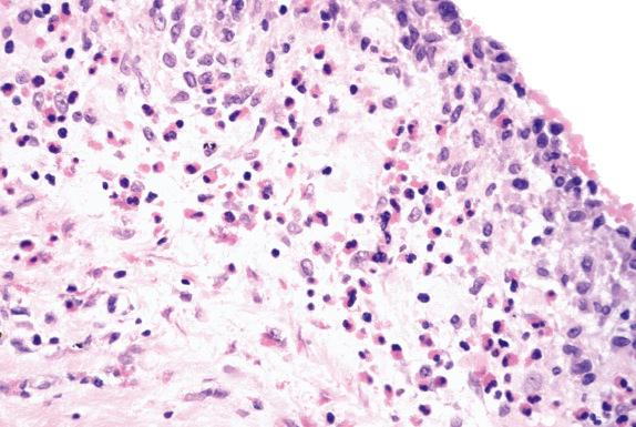 FIG. 34.3, Eosinophilic pleuritis, postpneumothorax. Note the prominent eosinophil infiltrates in the pleura and the thin layer of proliferating mesothelial cells.