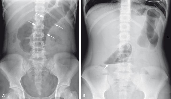 Figure 106.1, Toxic megacolon in a 13-year-old girl with ulcerative colitis.
