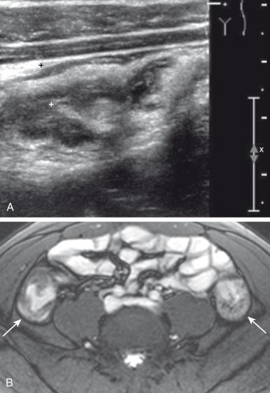 e-Figure 106.2, Crohn disease flare in a 15-year-old boy.