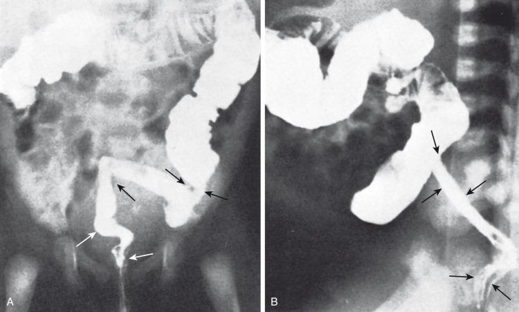 e-Figure 106.4, Infantile ulcerative colitis in a 3-week-old girl with rectal bleeding.