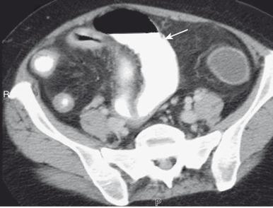 Figure 106.5, Active Crohn disease in a 19-year-old.