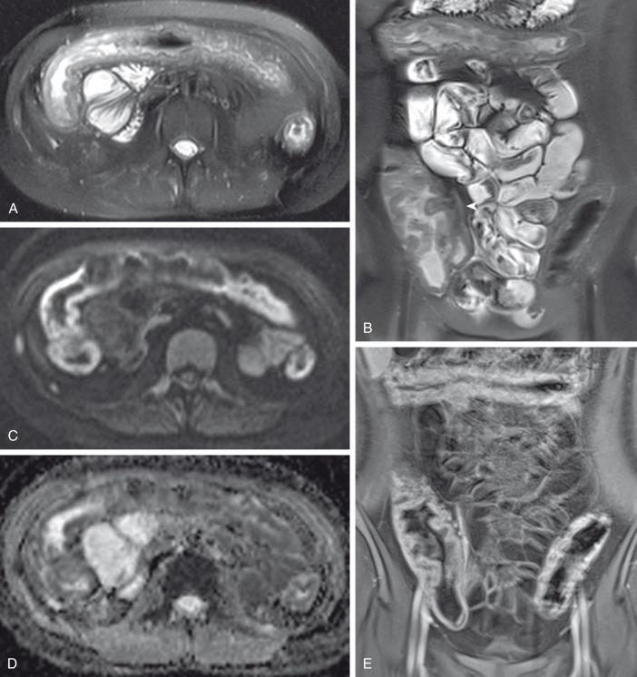 Figure 106.7, Ulcerative colitis with pancolitis on MR enterography.