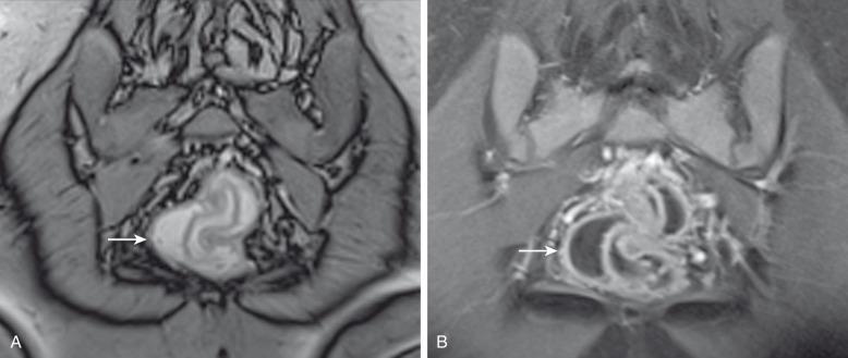 e-Figure 106.6, Chronic ulcerative colitis on MR enterography.