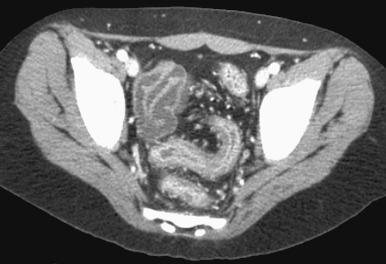 e-Figure 106.8, Ulcerative colitis in a 12-year-old.