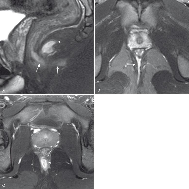 Figure 106.9, Perianal Crohn disease in a 17-year-old male.