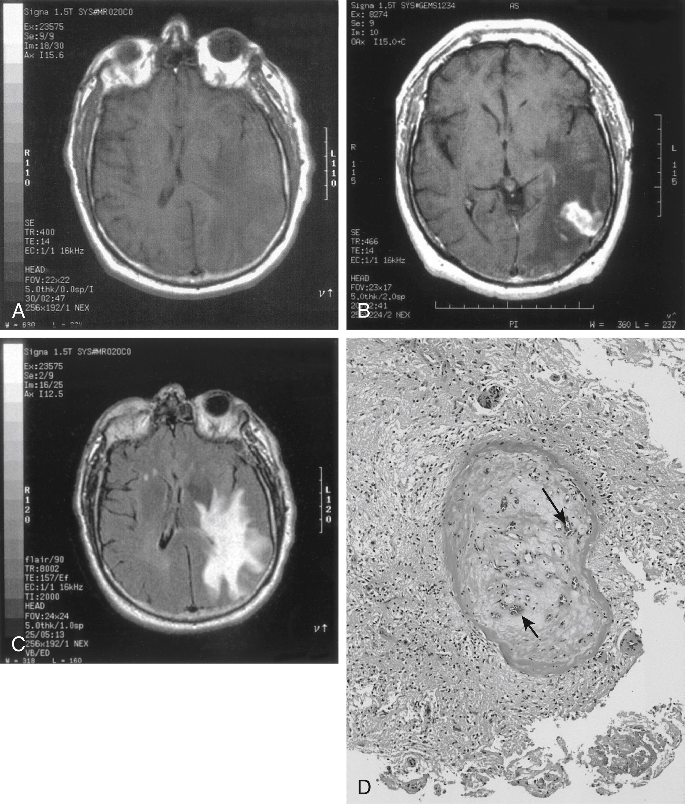 Fig. 36.1, Cerebral vasculitis manifesting as a mass lesion. T1-weighted magnetic resonance (MR) images before (A) and after (B) administration of contrast agent, showing the enhancement of a left temporoparietal mass lesion. (C) T2-weighted MR image showing extensive edema around the lesion. (D) Pathologic specimen from brain biopsy demonstrates an intraparenchymal blood vessel with chronic occlusive changes, mural fibrosis, and recanalization by small, thin-walled vessels (arrows) . The gray matter surrounding the blood vessel shows extensive gliosis and loss of neurons. Leukocytes, primarily lymphocytes, infiltrate the arterial adventitia and, to a lesser extent, the media—findings that are consistent with a chronic vasculitic process.