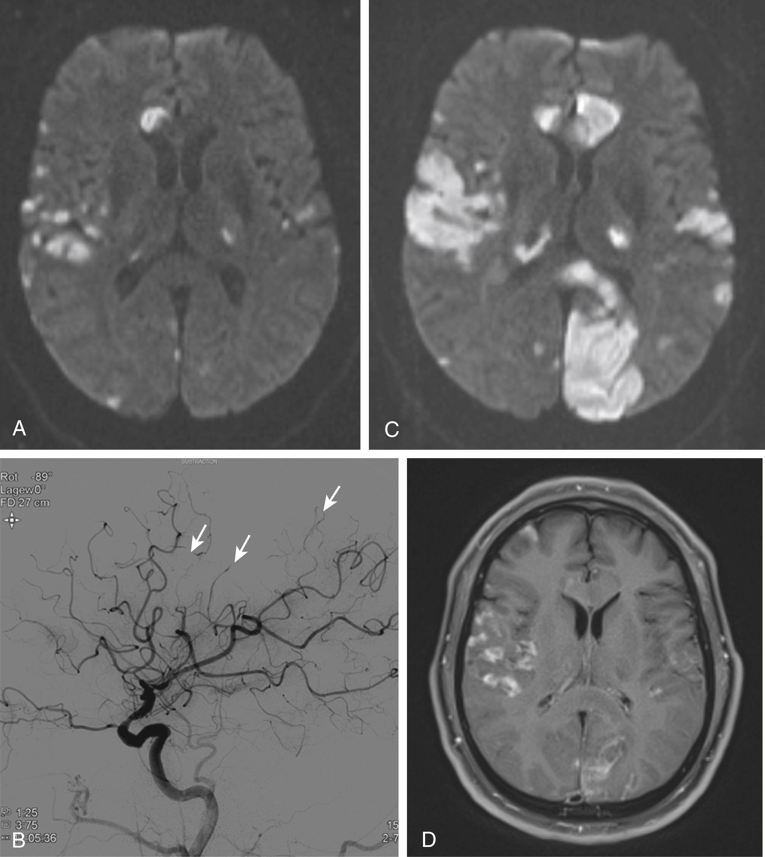 Fig. 36.2, Primary angiitis of the central nervous system. A 61-year-old man with a long history of smoking presented with a right partial third nerve palsy, dysarthria, and left central facial paresis. His relatives described 2 months of memory impairment and apraxia. Diffusion-weighted magnetic resonance imaging (MRI; A) showed multiple infarcts in bilateral cerebral hemispheres, and in both anterior and posterior circulations, including superficial and deep (right head of caudate) structures. Digital subtraction cerebral angiography (B) showed multiple areas of focal stenosis in the distal cerebral vessels (arrows) . Biopsy of the right temporal cortex and leptomeninges showed lymphocytic vasculitis with polynuclear giant cells and transmural inflammation and necrosis of the vessel wall consistent with primary angiitis of the central nervous system. Follow-up MRI 8 days later, after treatment with steroids and cyclophosphamide, showed new infarcts by diffusion-weighted imaging (C) and enhancement on T1 weighted-images (D). The patient was discharged to a rehabilitation center with cortical blindness, global aphasia, and left side hemiplegia; he died 10 months later despite therapy.
