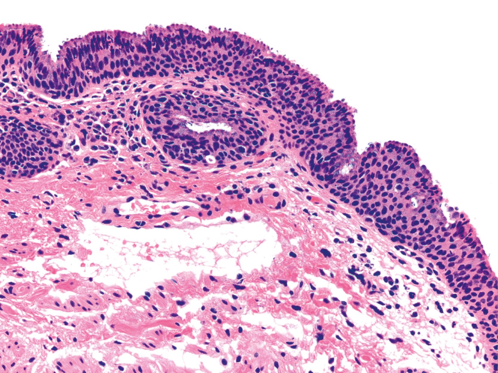 FIGURE 32.2, Normal histological appearance of the anal transition zone.