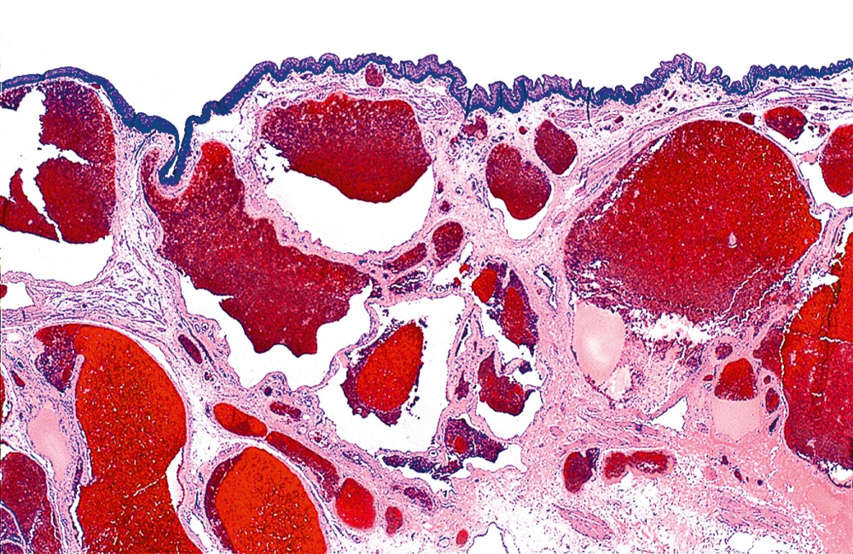 FIGURE 32.3, Low-power view of a hemorrhoid showing vascular dilation and thrombosis. Chronic inflammation of the intervening stroma is also present.