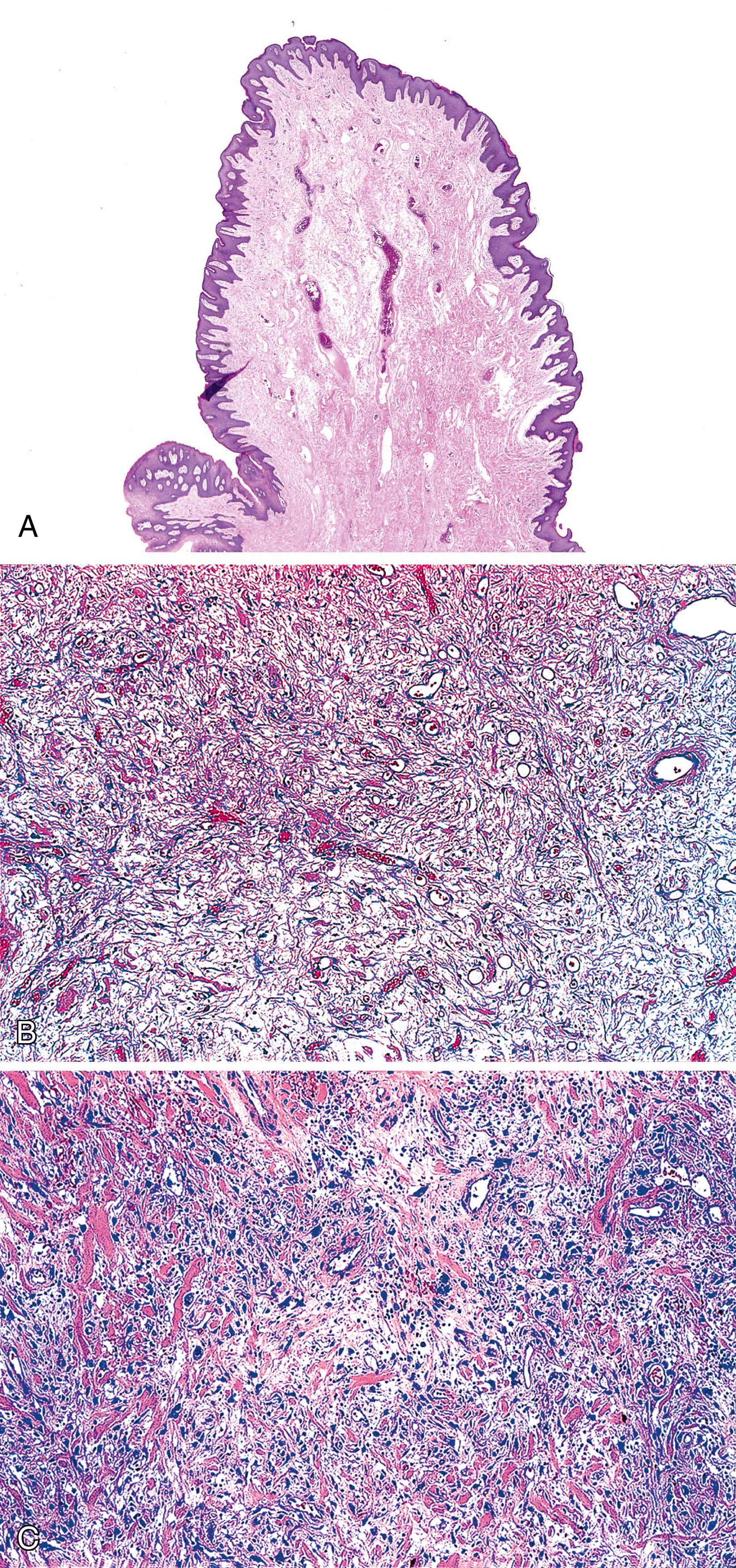 FIGURE 32.4, A, Low-power view of hypertrophic anal papillae (fibroepithelial polyp). In this example, the “tag” is lined by squamous epithelium and composed of fibrovascular connective tissue. B, High-power view of the fibroepithelial polyp stroma. C, In some anal tags, the stroma may contain numerous stellate fibroblasts with bizarre-shaped and multiple nuclei. These changes are reactive in nature and should not be confused with a stromal malignancy.