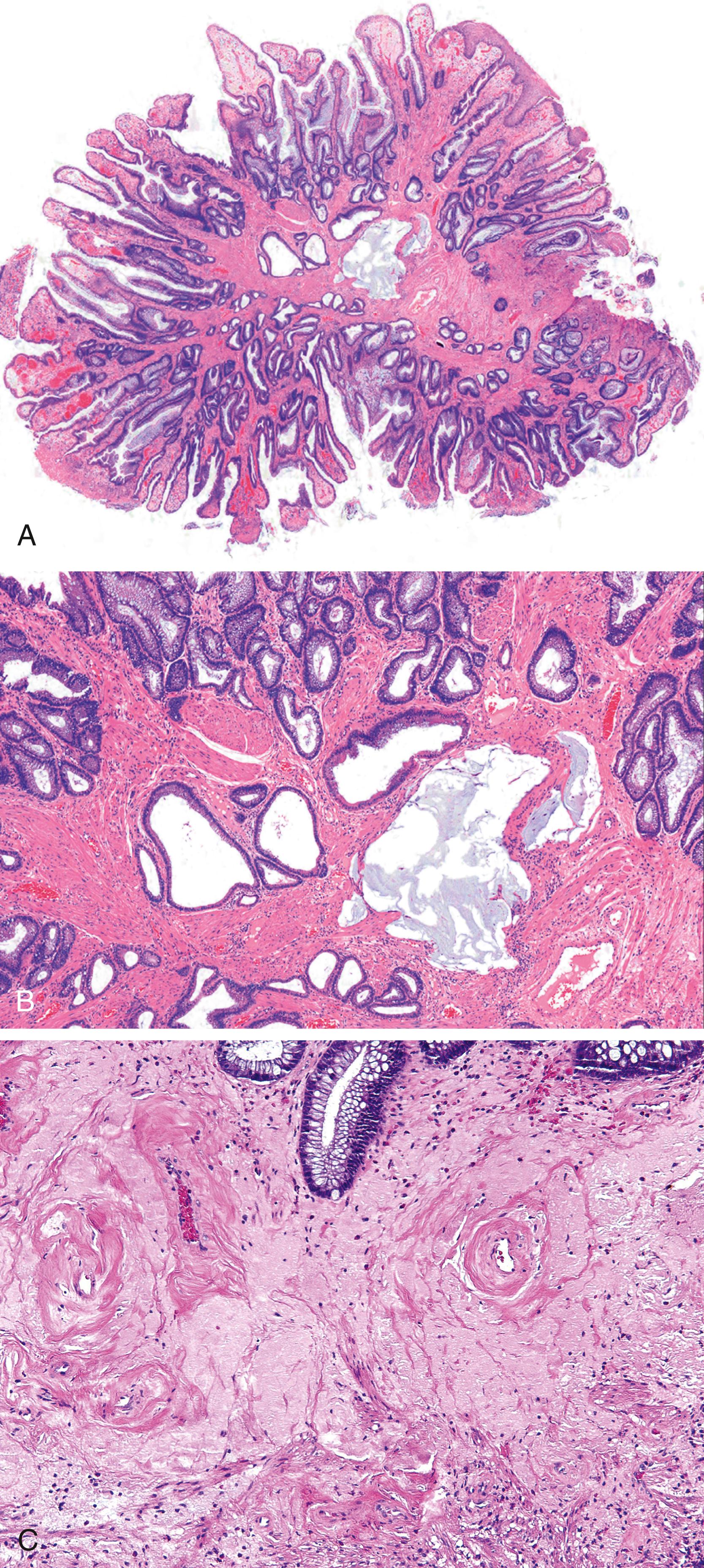 FIGURE 32.5, A, Low-power view of an inflammatory cloacogenic polyp. These lesions have a villiform appearance, incorporate anal squamous epithelium, display prominent crypt distortion, and show reactive epithelial changes. The epithelium often has a serrated architectural appearance that can cause diagnostic confusion with a serrated neoplasm. B, High-power view reveals smooth muscle ingrowth between the crypts and misplaced nonneoplastic crypts and acellular mucin. C, Stromal deposition of elastin, which is pale staining, among more densely eosinophilic collagen and smooth muscle. The elastin is a helpful clue to chronic trauma-related injury.