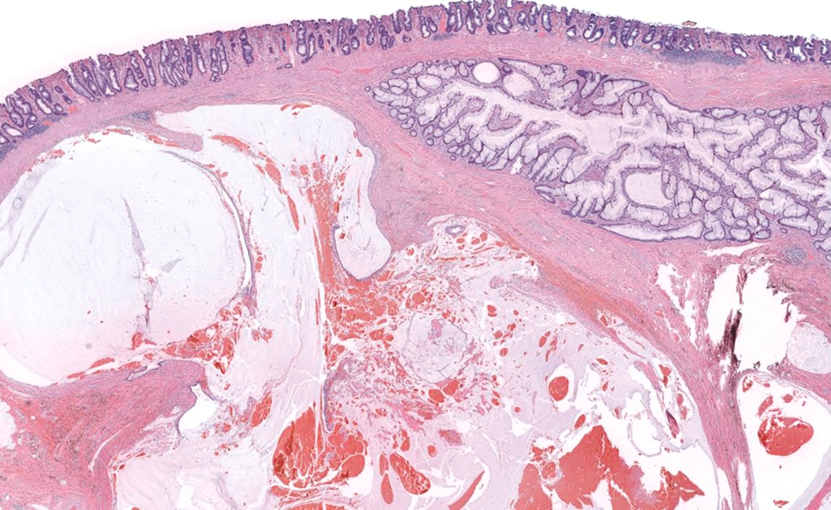 FIGURE 32.6, Low-power view of typical histological findings in proctitis cystica profunda in which well-circumscribed nests of misplaced rectal epithelium and pools of extracellular mucin are seen in the submucosa. This misplaced epithelium is invested by lamina propria, with a surrounding stroma that may show hemorrhage and associated hemosiderin-laden macrophages.