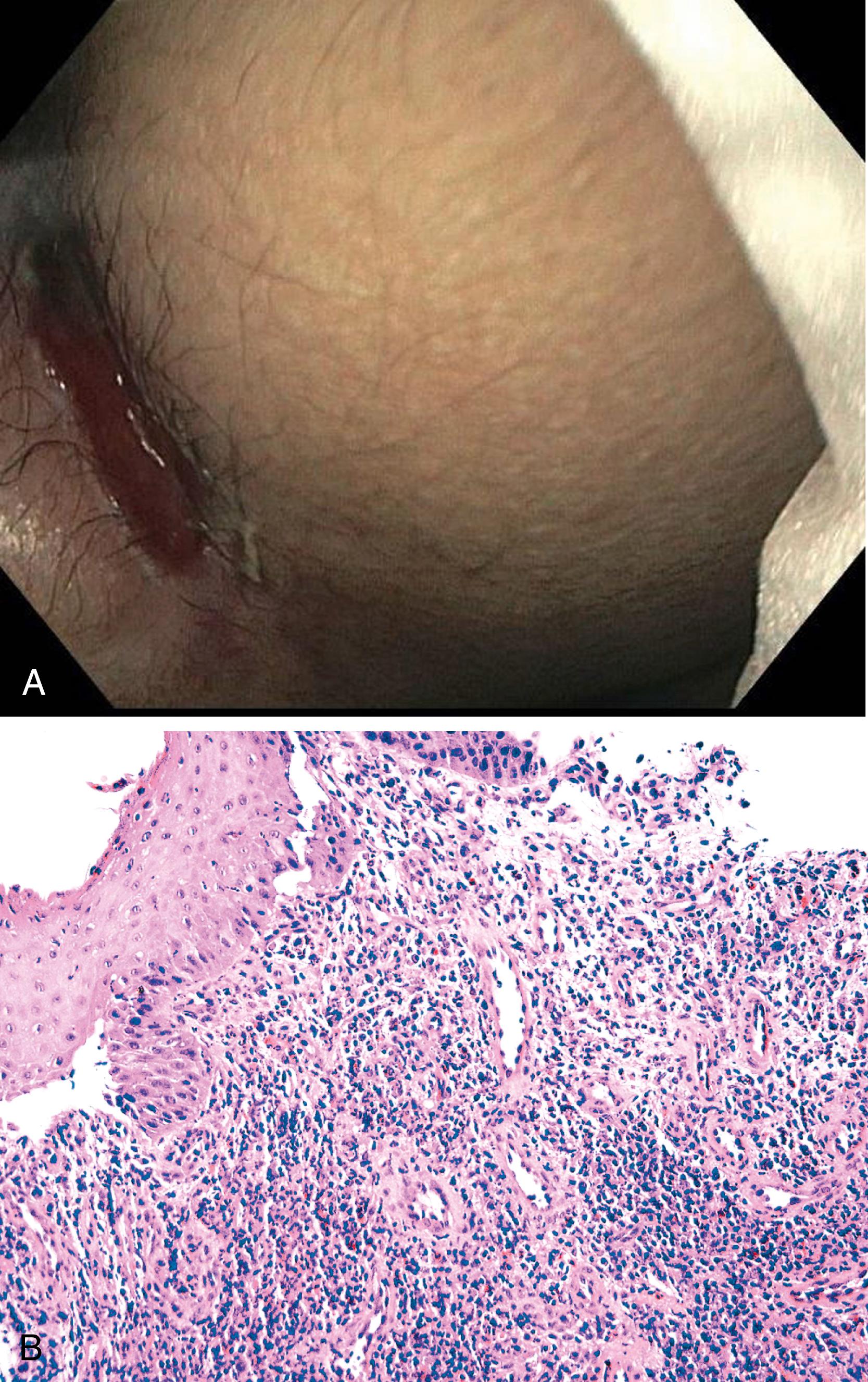 FIGURE 32.7, A, Chronic anal fissure at anoscopy. B, Typical histological findings in anal tear/fissure/ulcer. A mucosal break leads to inflammation and reactive changes of the overlying squamous epithelium (upper left) and intensely inflamed granulation tissue at the base of the break.