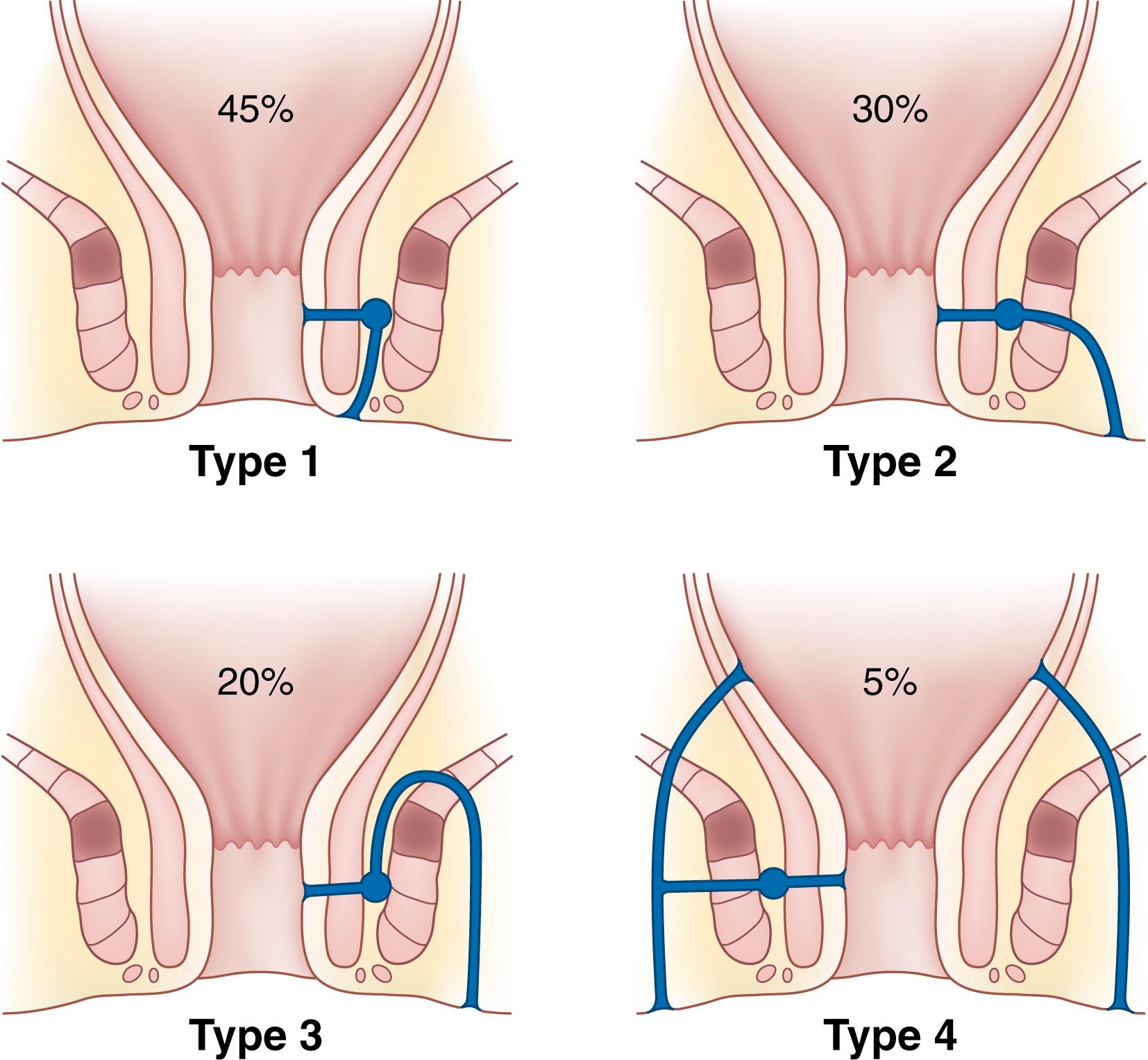 FIGURE 32.8, Anatomical classification of the four main types of fistulas, including intersphincteric (type 1), trans-sphincteric (type 2), suprasphincteric (type 3), and extrasphincteric (type 4).