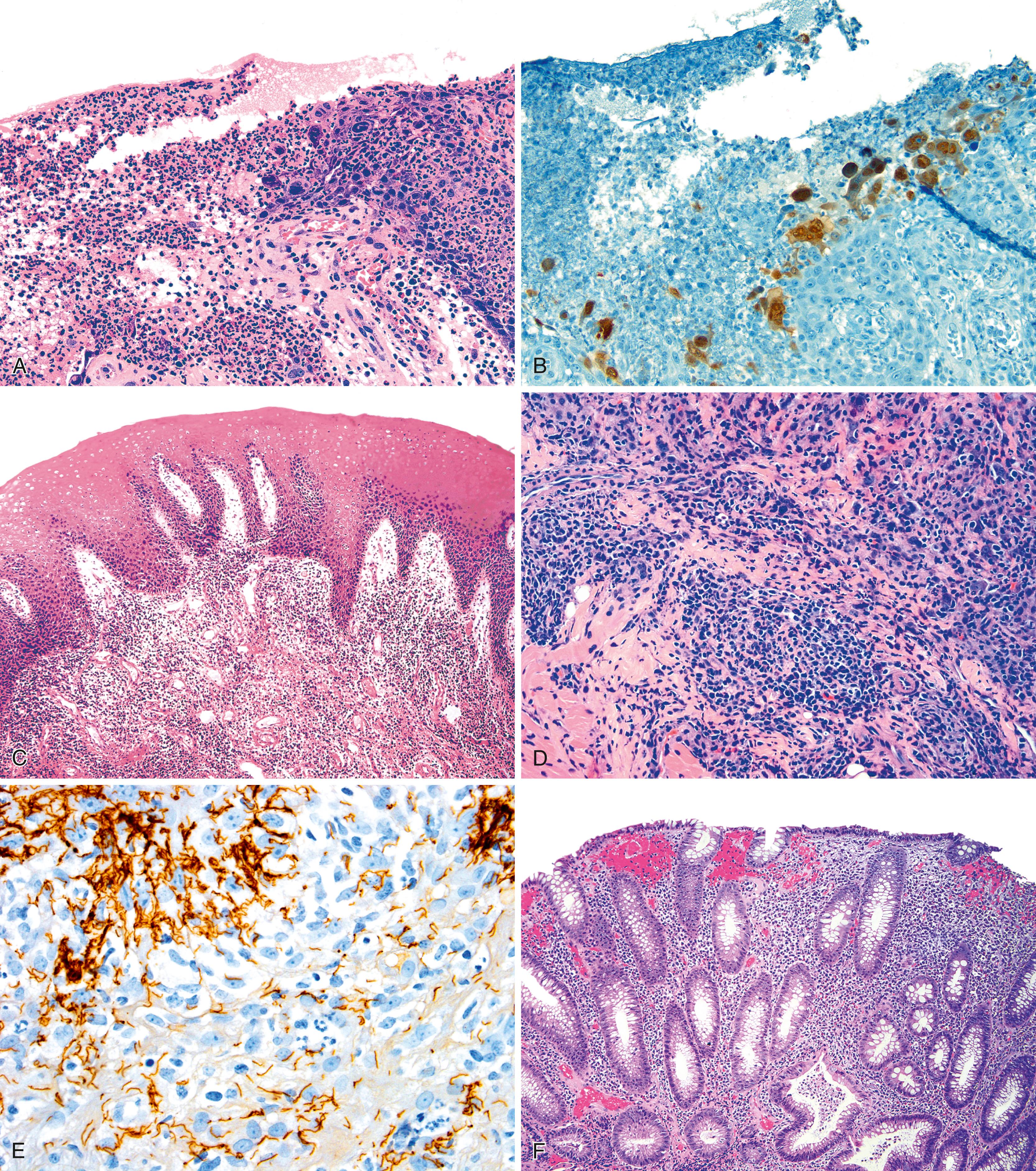 FIGURE 32.9, Histological features of common infections of the anal canal.