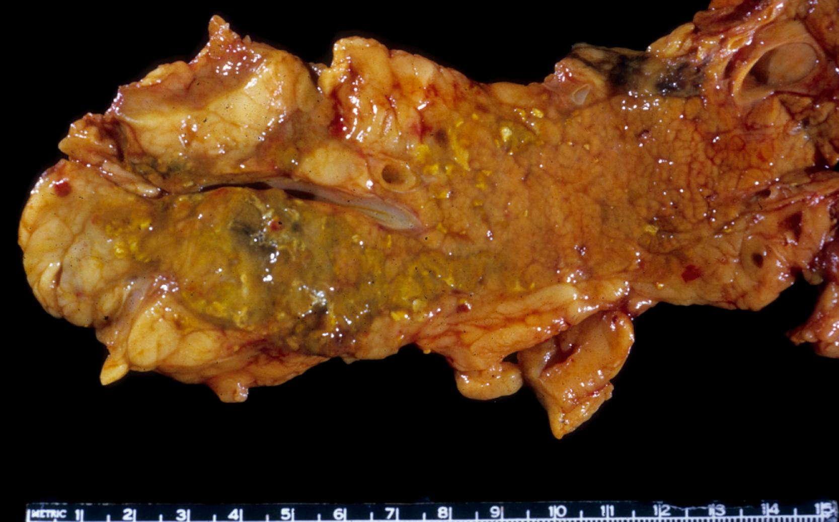 FIGURE 40.1, Acute pancreatitis. This cross section of the pancreas shows yellow specks in the fat, consistent with fat necrosis.