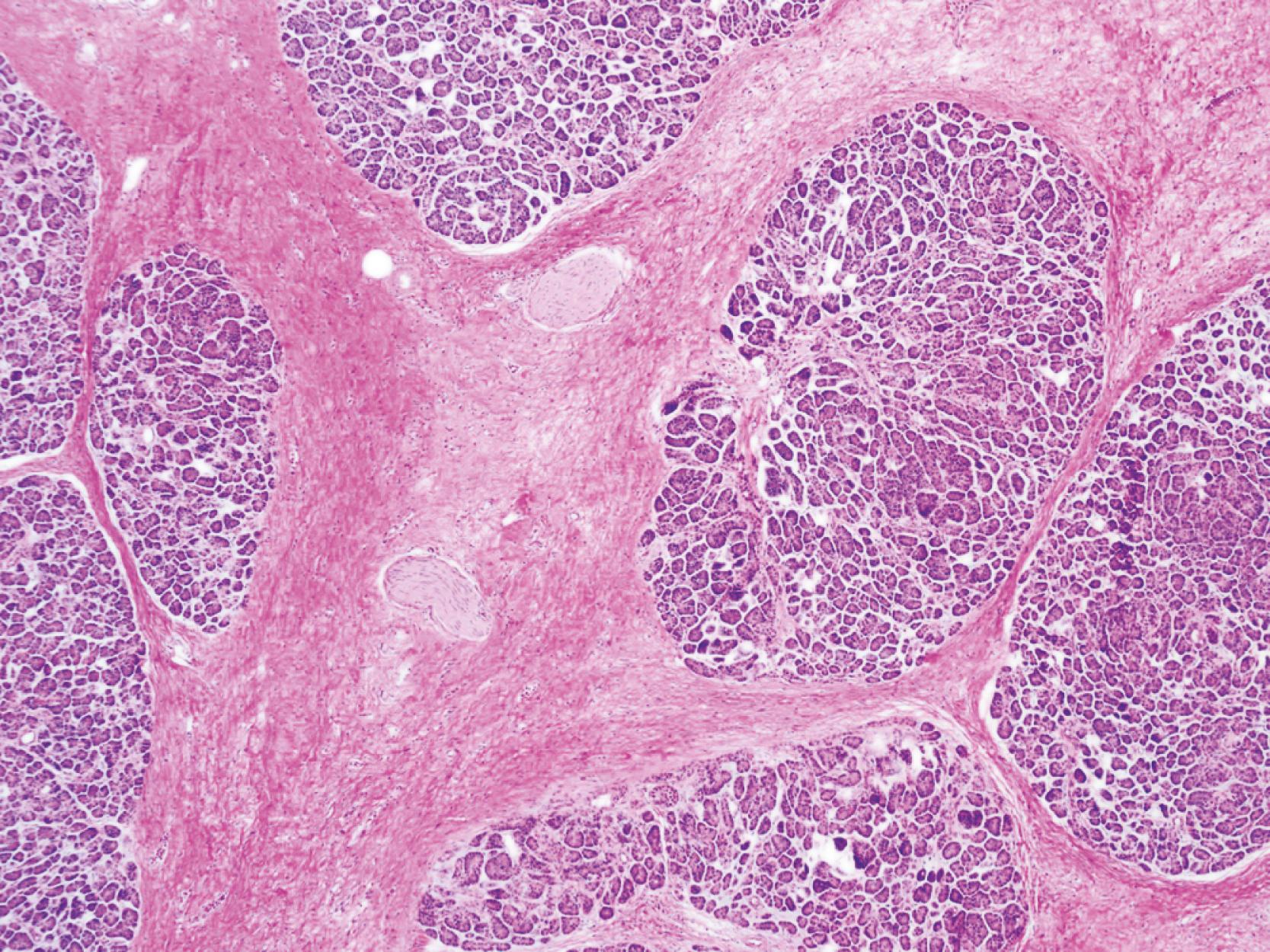 FIGURE 40.3, Alcoholic chronic pancreatitis. Dense interlobular fibrosis with preserved zones of acinar cells between the septa are seen. In comparison with autoimmune pancreatitis, the stroma is relatively acellular and lacks an inflammatory infiltrate.