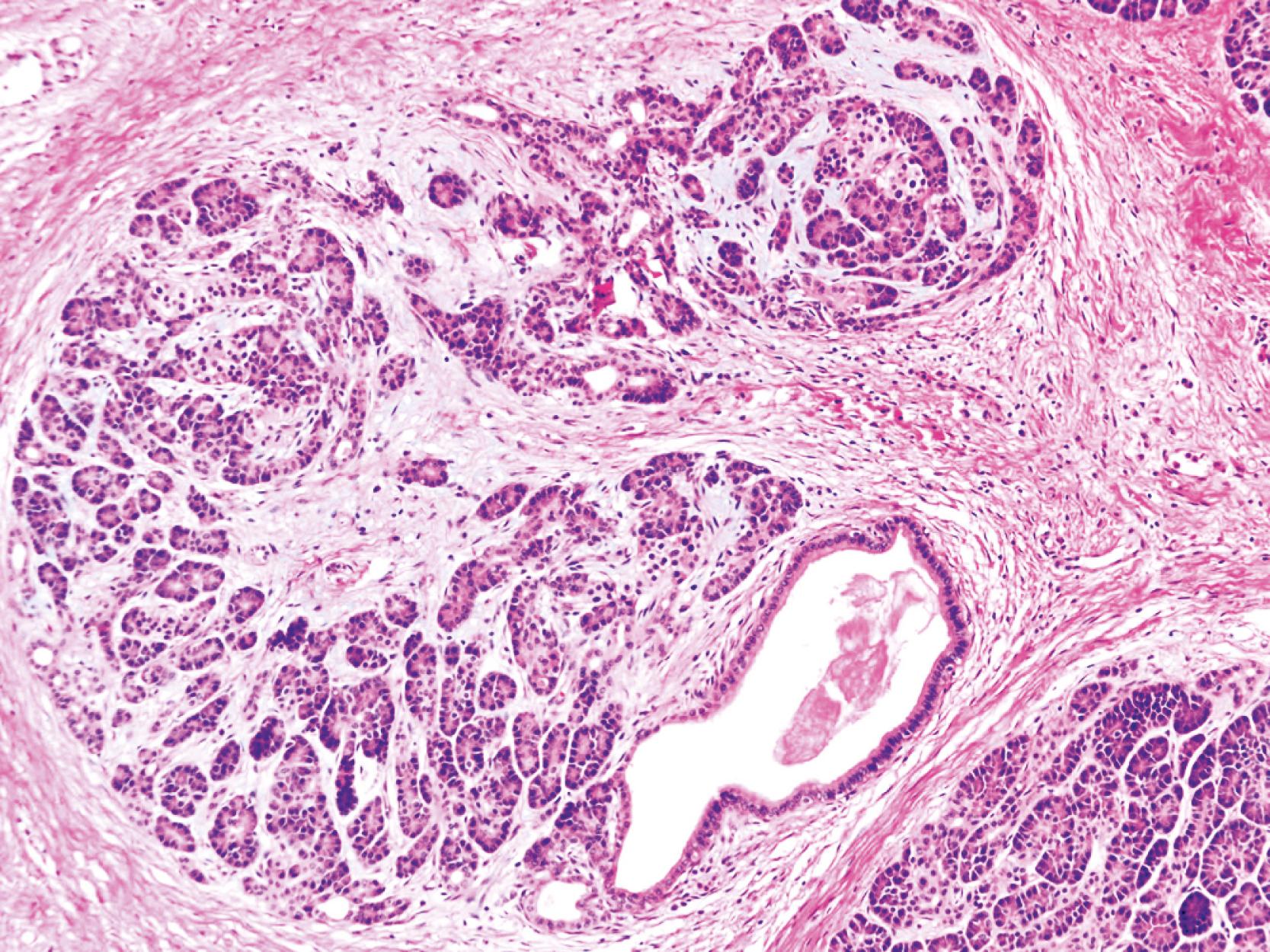 FIGURE 40.4, Alcoholic chronic pancreatitis. The dilated duct is filled with inspissated proteinaceous material. Also notice the presence of interlobular and intralobular fibrosis.