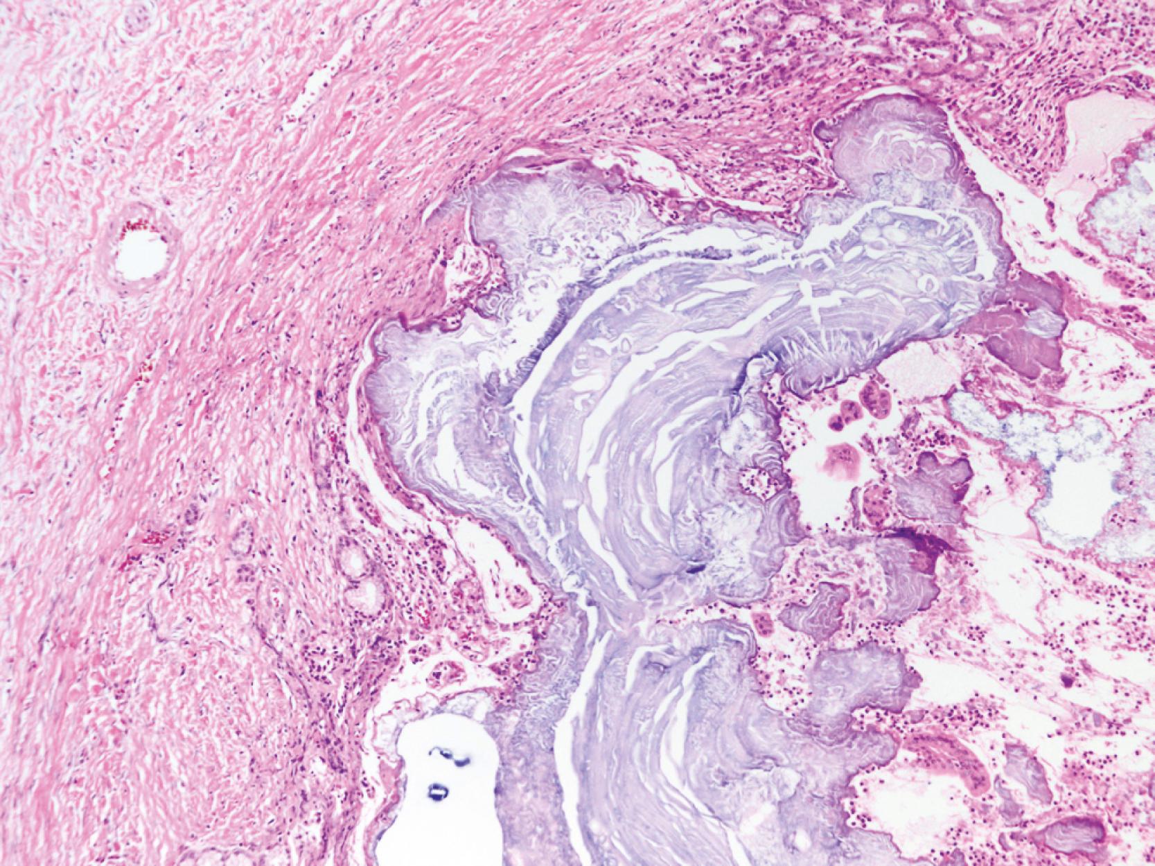 FIGURE 40.5, Alcoholic chronic pancreatitis. An impacted stone is present in a markedly dilated duct.