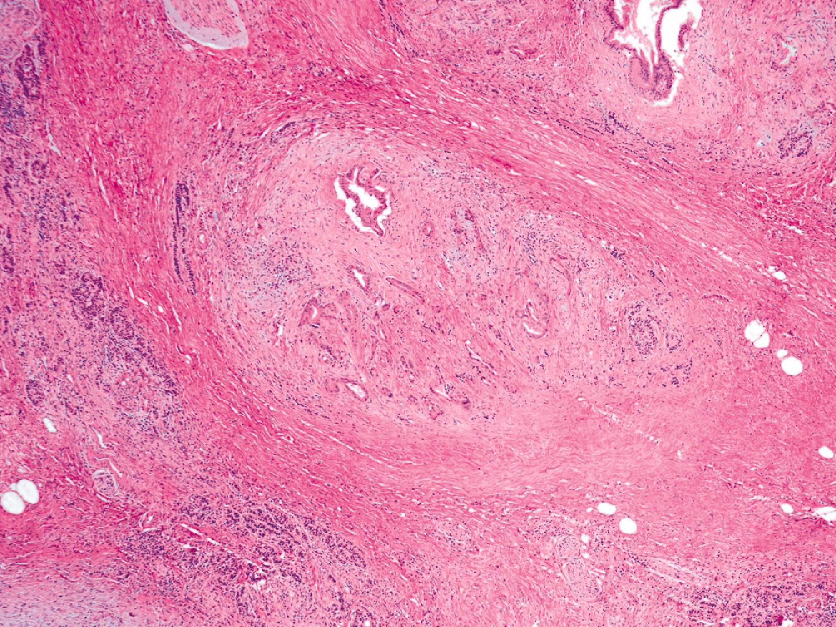 FIGURE 40.6, Chronic pancreatitis. The presence of ductal structures in a lobular configuration virtually rules out the diagnosis of pancreatic adenocarcinoma.