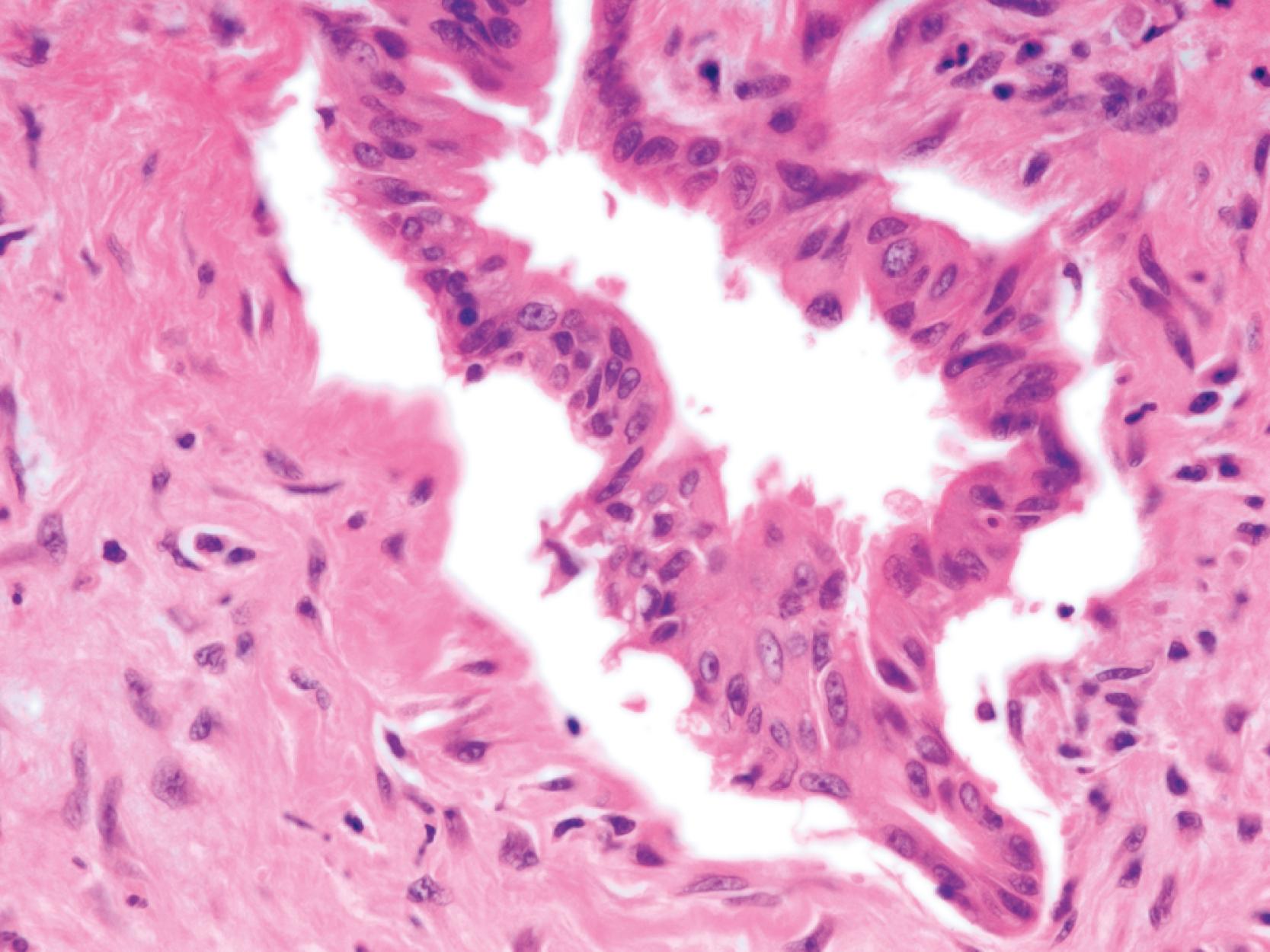 FIGURE 40.7, Chronic pancreatitis with cytological atypia. In isolation, the anisonucleosis and nuclear atypia raise the possibility of a pancreatic adenocarcinoma. However, this duct is located within a lobule (shown in Fig. 40.6), supporting a benign interpretation.