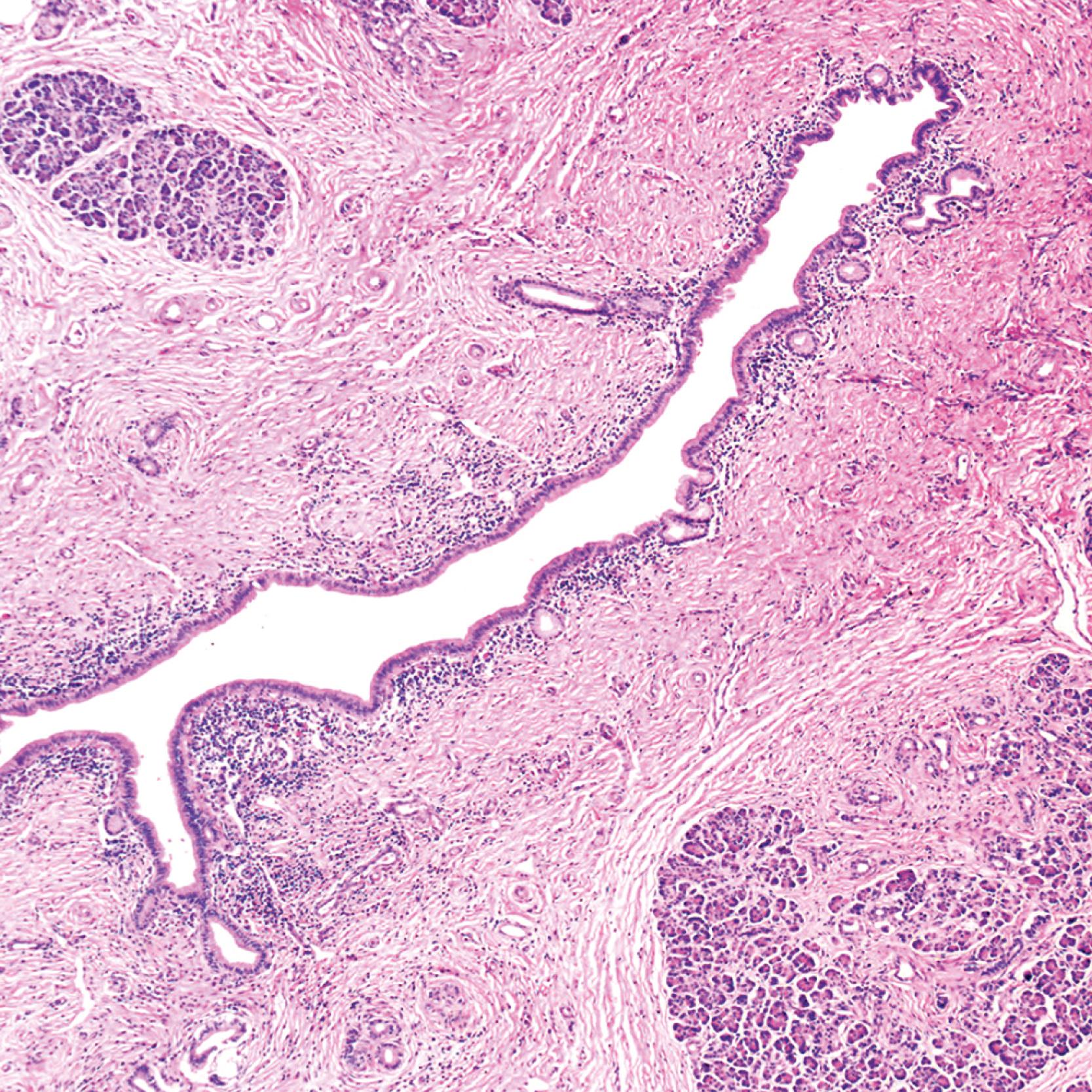 FIGURE 40.9, Chronic pancreatitis. This pancreas was resected from a 25-year-old male patient with a cationic trypsinogen mutation. Note the periductal inflammation.