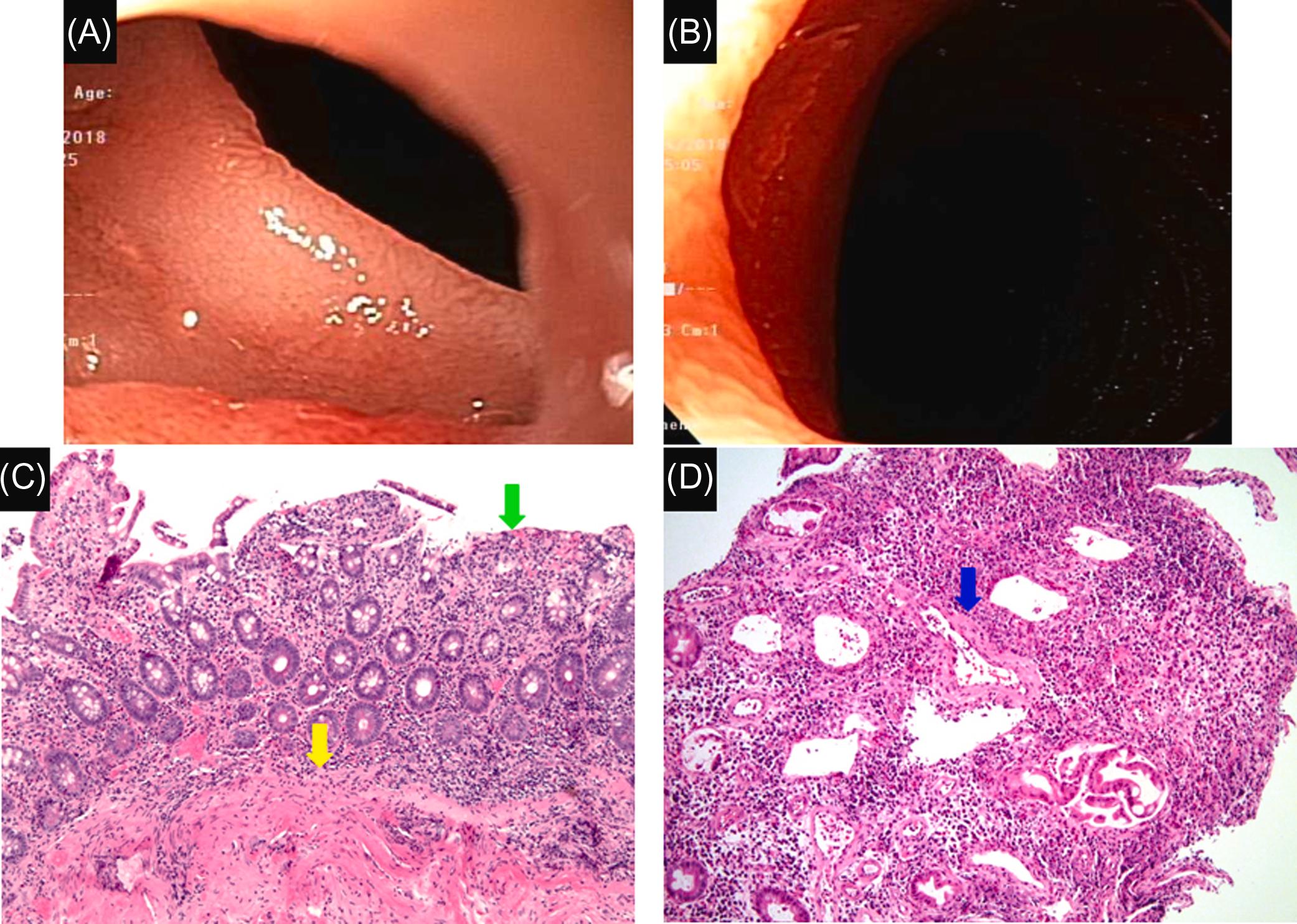 Figure 29.11, Nonsteroidal antiinflammatory drug-induced duodenal diaphragm: (A) and (B) diaphragm at the duodenum cap which was not traversable to a gastroscope; (C) and (D) histology of endoscopic biopsy showed erosions ( green arrow ), fibrosis of the muscularis mucosae ( yellow arrow ), and hyalinized vessels ( blue arrow ).