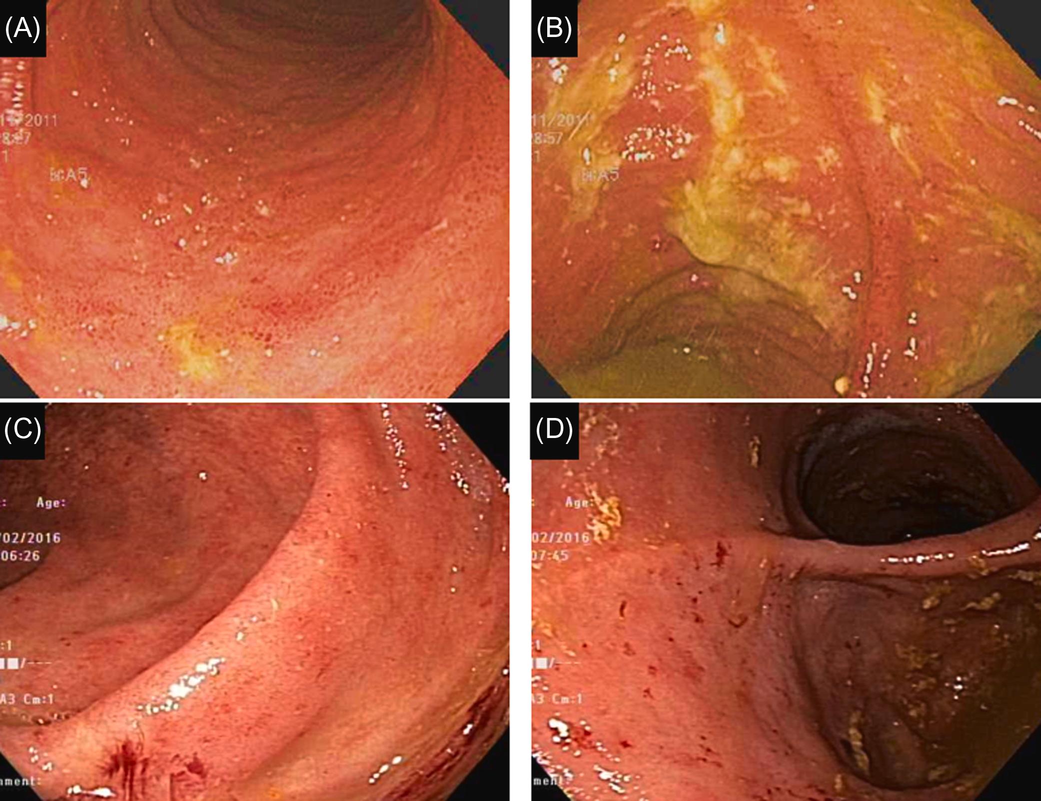 Figure 29.12, Nonsteroidal antiinflammatory drug-induced enteritis and pouchitis in a patient with restorative proctocolectomy for ulcerative colitis: (A) mild diffuse inflammation with small erosions and loss of vascularity of the afferent limb; (B)–(D) diffuse pouchitis with exudates, erythema, edema, and spontaneous bleeding of the pouch body.