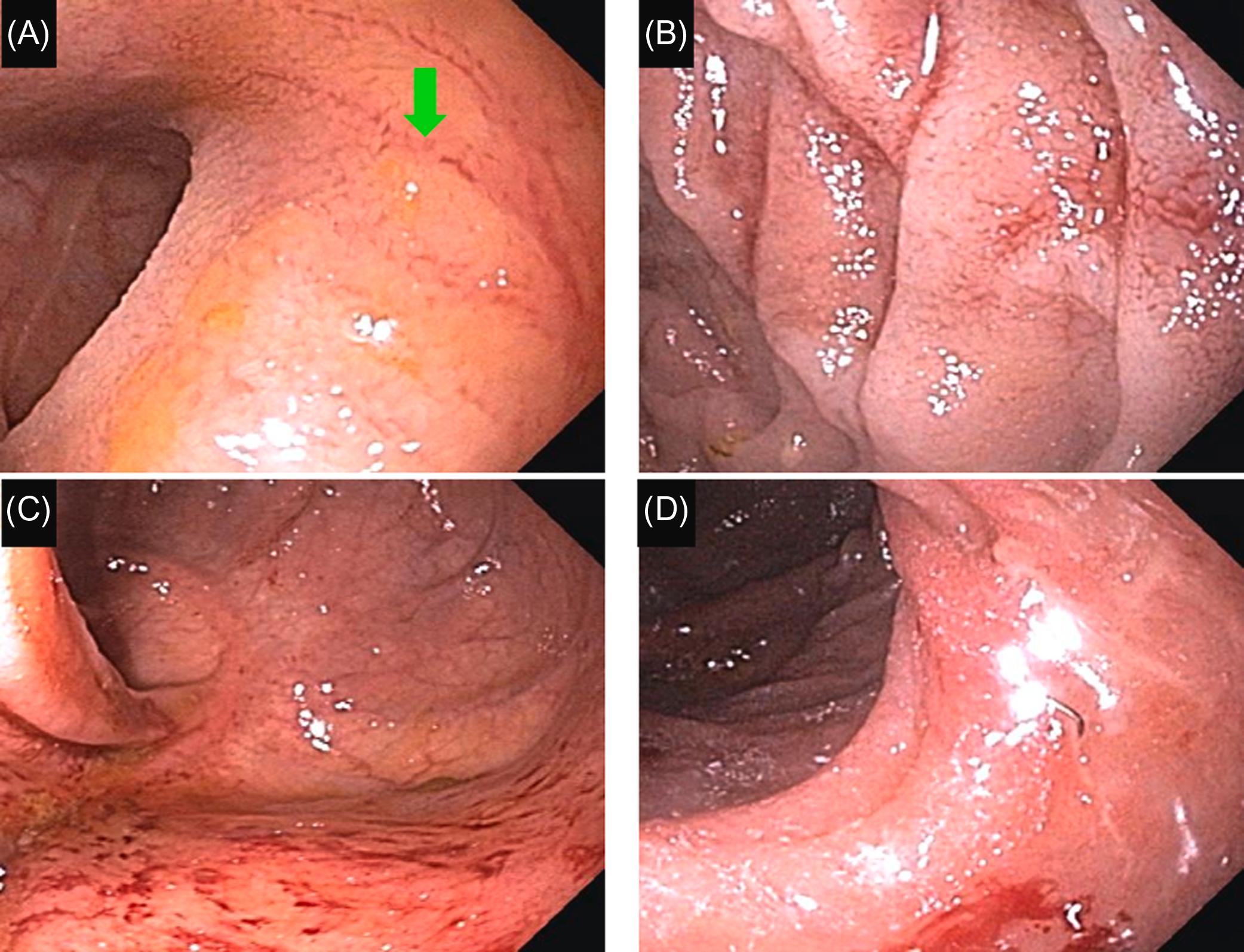 Figure 29.13, Enteritis, pouchitis, and cuffitis associated with the use of nonsteroidal antiinflammatory drugs in an ulcerative colitis patient with restorative proctocolectomy: (A) and (B) enteritis with prominent linear mucosal vasculature ( green arrow ), edema, erythema, and mucosal breaks; (C) hemorrhagic pouchitis; (D) edema of the rectal cuff.