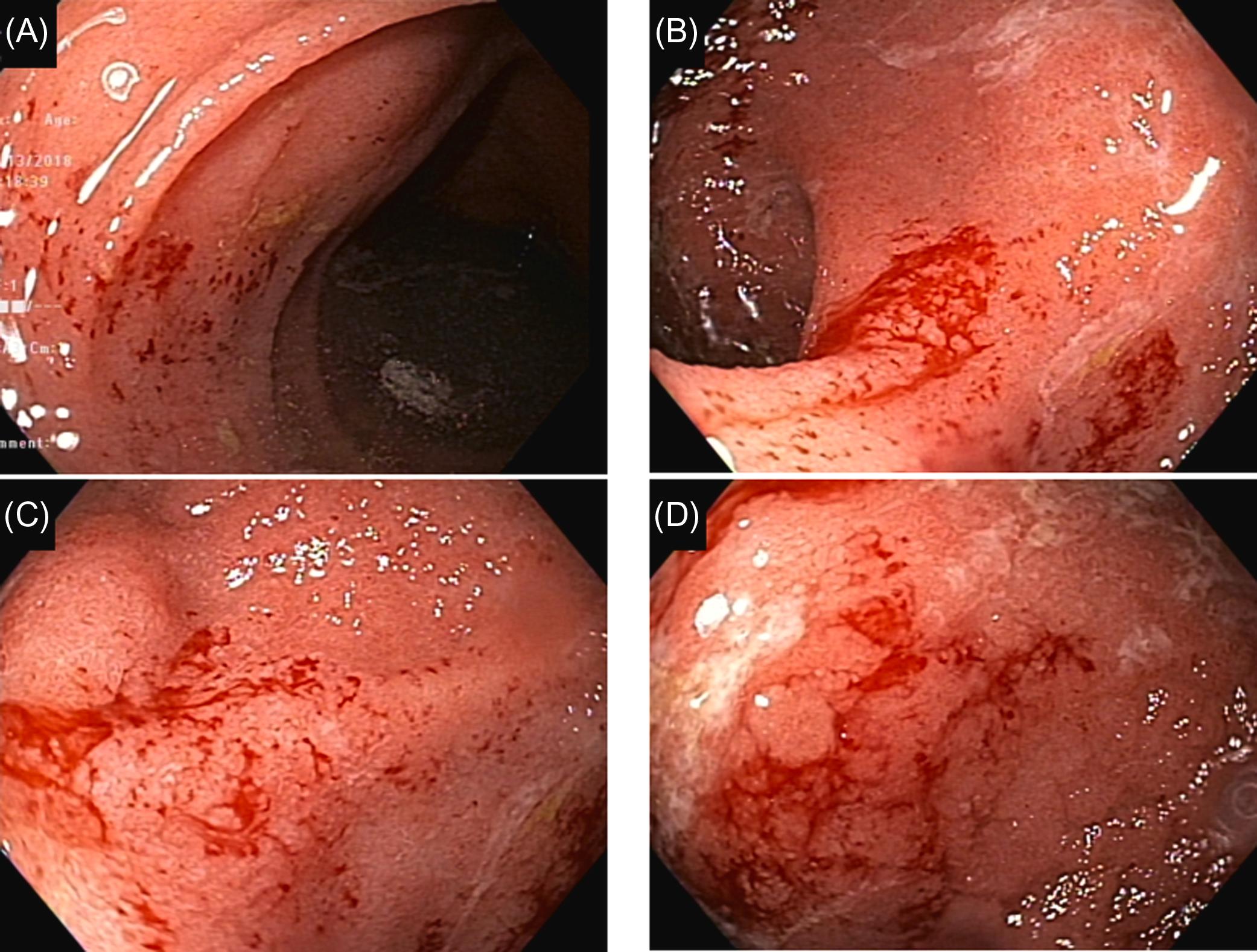 Figure 29.14, Nonsteroidal antiinflammatory drug-induced hemorrhagic enteritis and pouchitis: (A) spontaneous bleeding in the afferent limb; (B)–(D) friable mucosa and spontaneous bleeding of the pouch body.