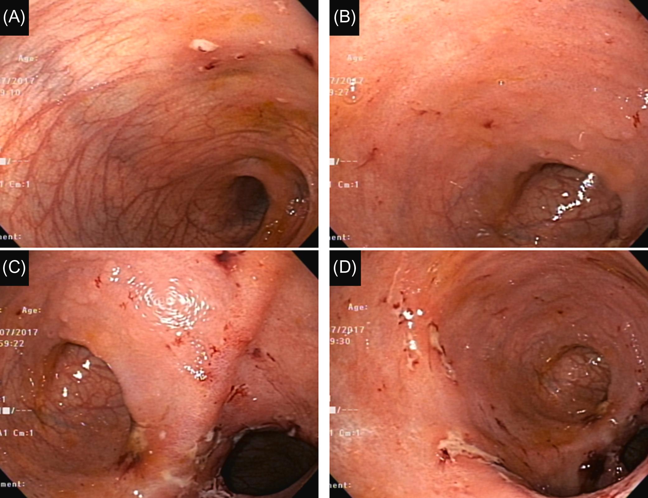 Figure 29.15, Nonsteroidal inflammatory drug-associated ulcers in the ileal pouch-anal anastomosis: (A) discrete erosions and ulcers with stigmata of bleeding in the afferent limb; (B)–(D) discrete erosions and ulcers with stigmata of bleeding in the pouch body.