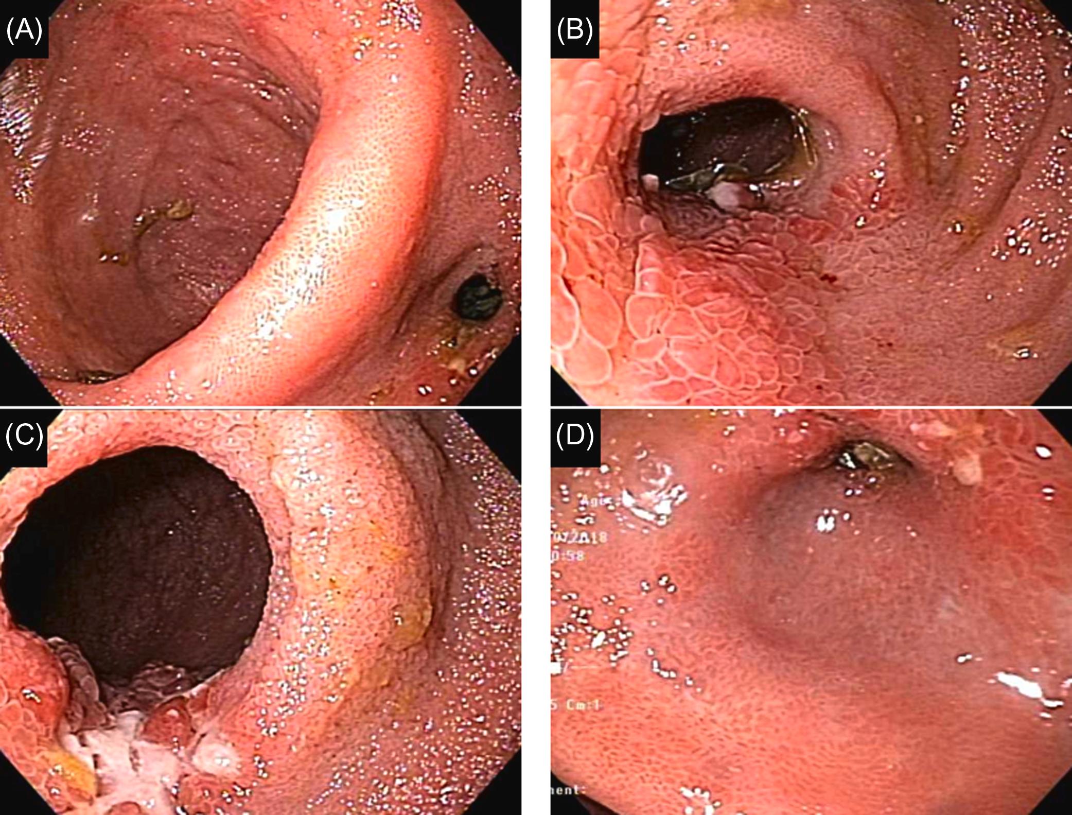 Figure 29.16, Ileal pouch strictures associated with the regular use of nonsteroidal antiinflammatory drugs in patients with restorative proctocolectomy: (A) normal pouch body; (B) and (C) two ulcerated strictures at the afferent limb; and (D) ulcerated stricture at the inlet.