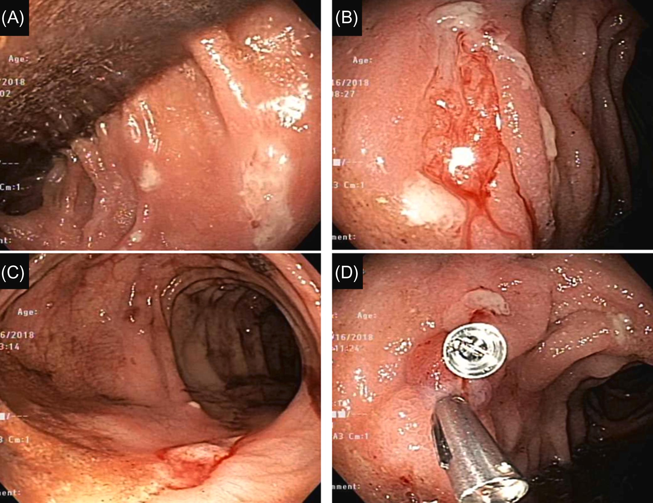 Figure 29.18, Patient with Crohn’s colitis using potassium citrate: (A) multiple colonic ulcers; (B)–(C) actively oozing ulcers; and (D) hemostasis achieved using endoclips.