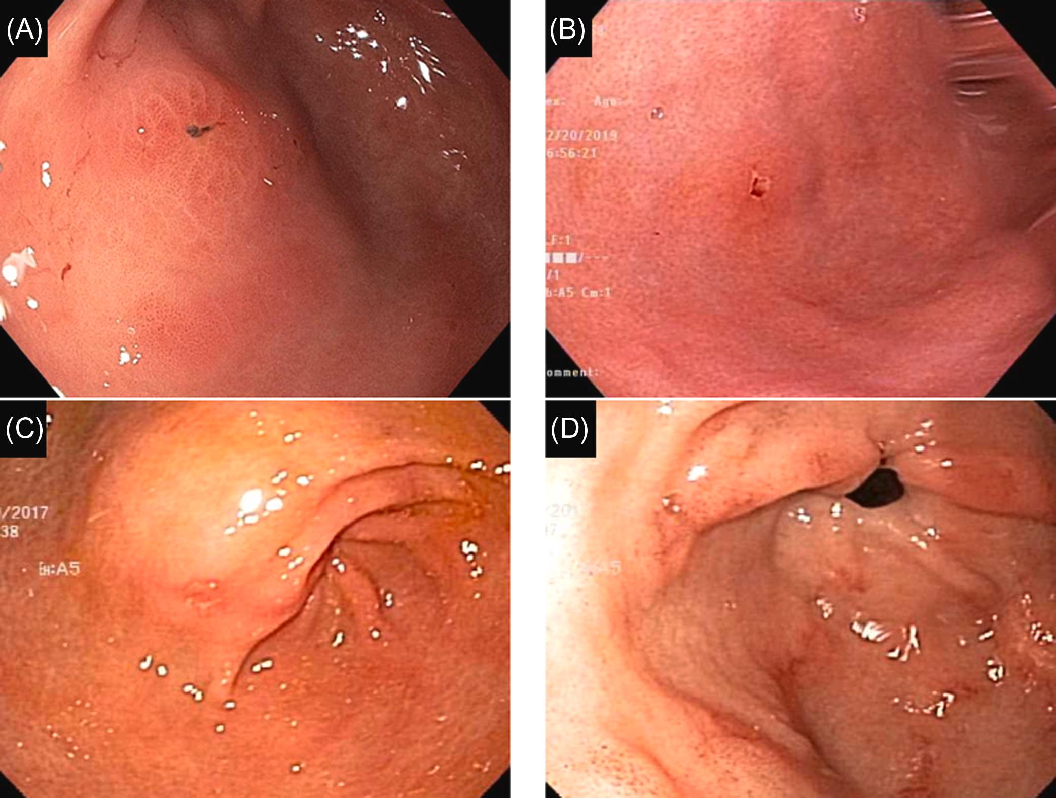 Figure 29.2, Patterns of nonsteroidal antiinflammatory drug-induced gastritis: (A) and (B) erosions with hematin spots in the antrum; (C) erosions, erythema, and edematous folds in the gastric antrum and prepyloric area; and (D) linear erosions in the stomach body with stigmata of recent bleeding.