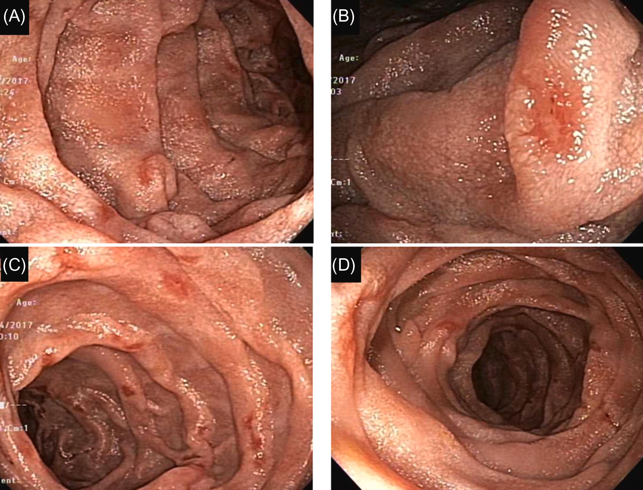 Figure 29.4, Nonsteroidal antiinflammatory drug-induced duodenitis: (A)–(D) multiple erosions and aphthous ulcers throughout the duodenum with normal intervening mucosa.