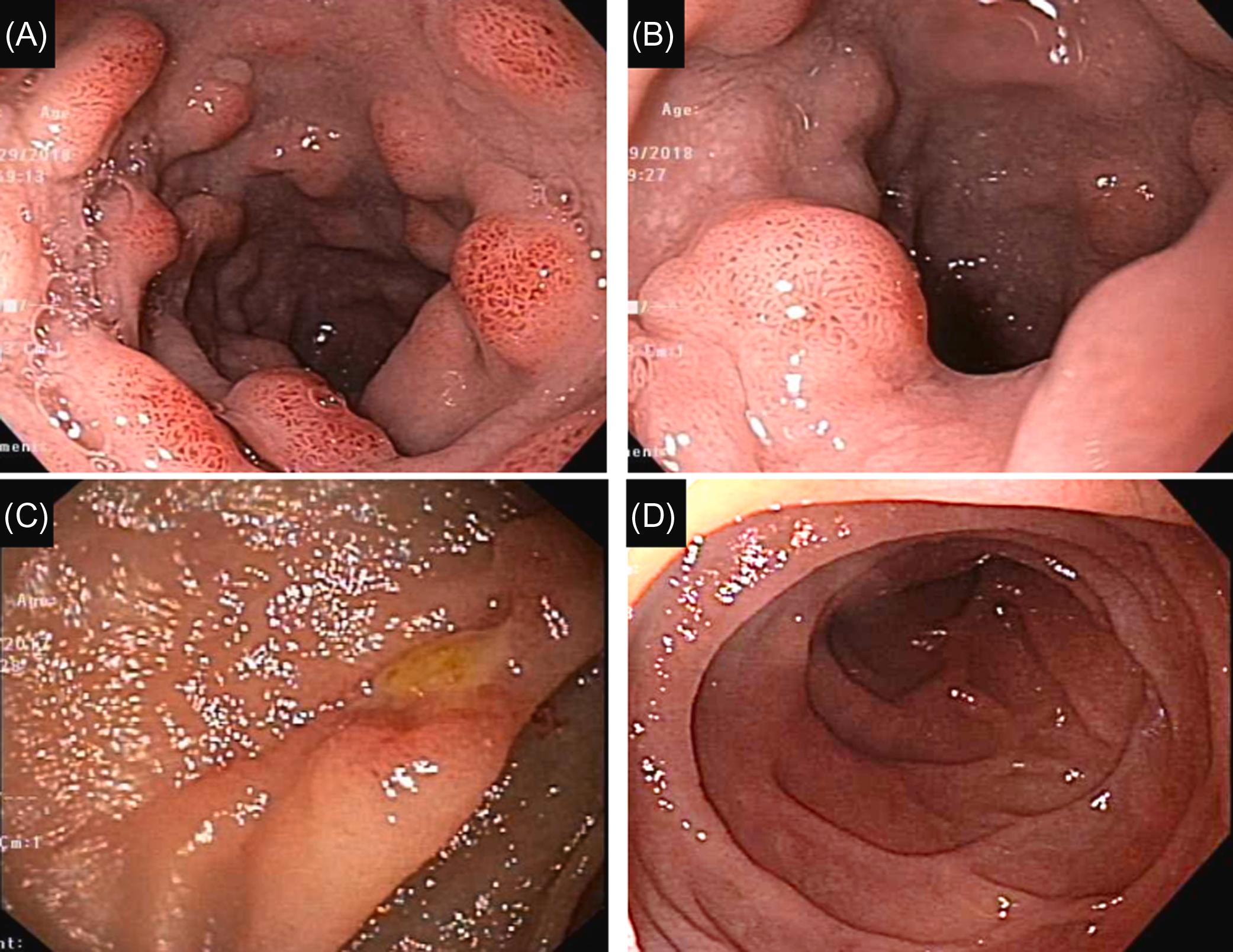 Figure 29.5, Nonsteroidal antiinflammatory drug-induced duodenitis: (A)–(C) erythematous, nodular, and congested duodenum mucosa; (D) normal distal duodenum.