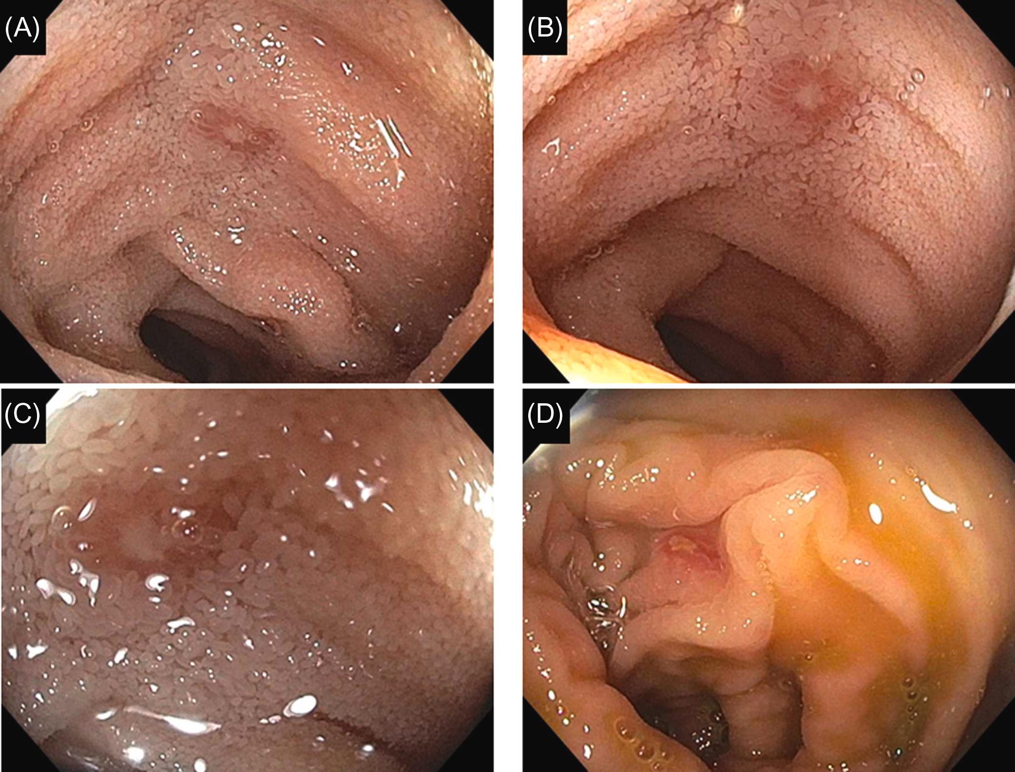 Figure 29.6, Nonsteroidal antiinflammatory drug-induced erosions in the ileum and colon in a patient with otherwise quiescent Crohn’s disease in the same patient: (A)–(C) aphthous ulcers with normal intervening mucosa; (D) single erosion in the ascending colon.