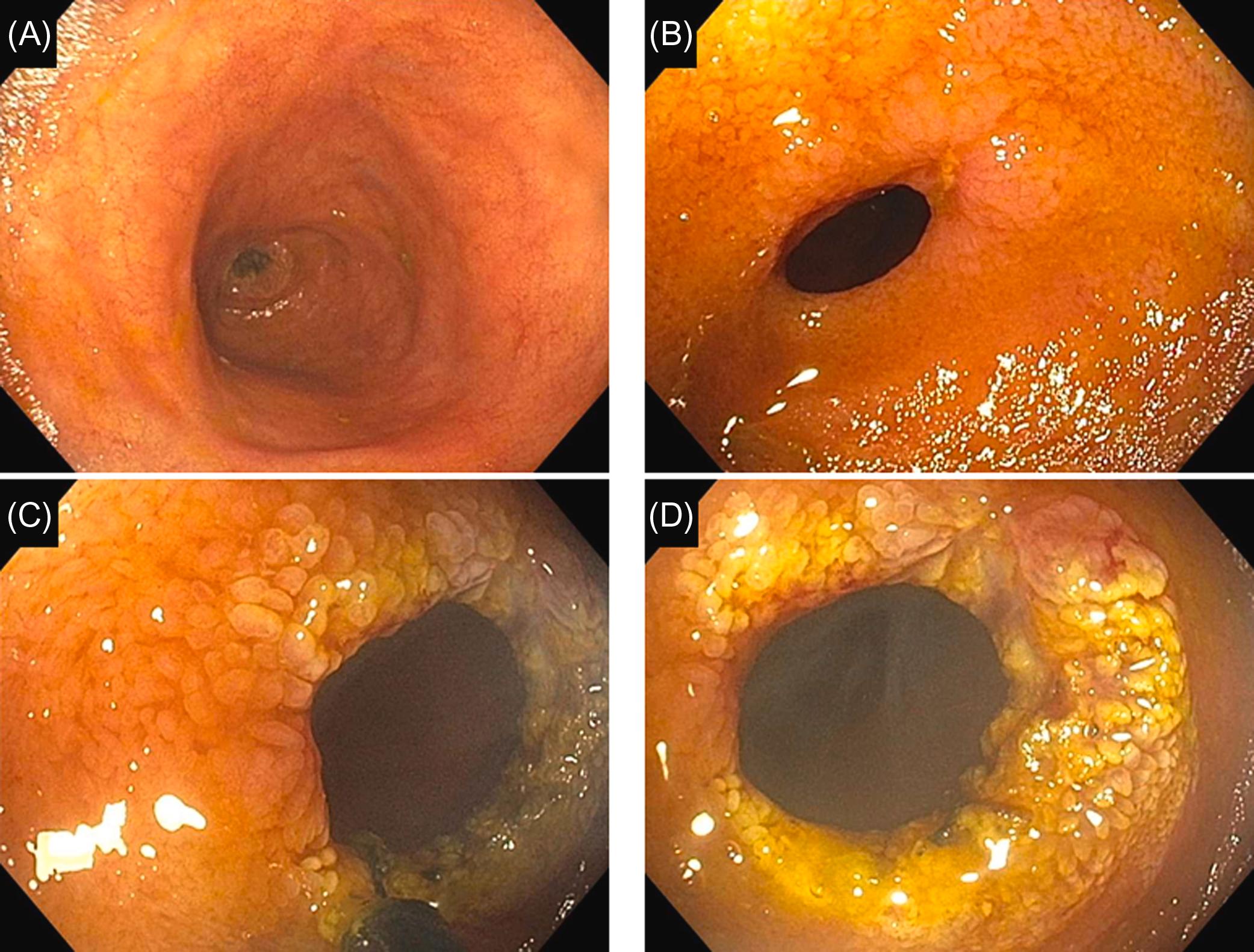 Figure 29.9, Ileal stricture from the use of nonsteroidal antiinflammatory drugs in a patient with Crohn’s disease: (A) and (B) circumferential stricture with a superficial erosion in the distal ileum. The ileum mucosa was otherwise normal. Crohn’s disease was in remission; (C) and (D) the stricture was treated with endoscopic stricturotomy with an insulated-tip knife and cauterization effect.